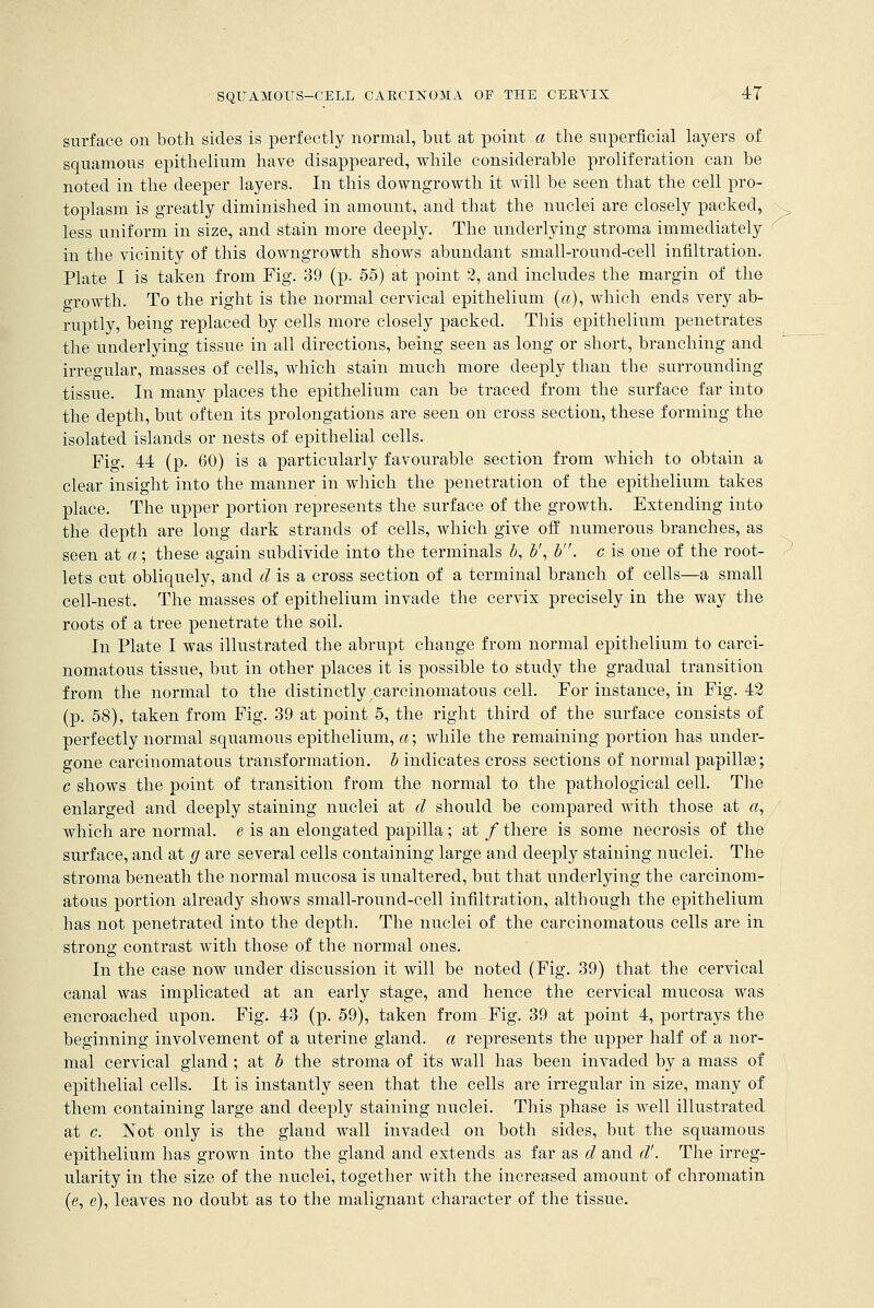 surface on both sides is perfectly normal, but at point a the superficial layers of squamous epithelium have disappeared, while considerable proliferation can be noted in the deeper layers. In this downgrowth it will be seen that the cell pro- toplasm is greatly diminished in amount, and that the nuclei are closely packed, less uniform in size, and stain more deeply. The underlying stroma immediately in the vicinity of this downgrowth shows abundant small-round-cell infiltration. Plate I is taken from Fig. 39 (p. 55) at point 2, and includes the margin of the growth. To the right is the normal cervical epithelium («), which ends very ab- ruptly, being replaced by cells more closely packed. This epithelium penetrates the underlying tissue in all directions, being seen as long or short, branching and irregular, masses of cells, which stain much more deeply than the surrounding tissue. In many places the epithelium can be traced from the surface far into the depth, but often its prolongations are seen on cross section, these forming the isolated islands or nests of epithelial cells. Fig. 44 (p. 60) is a particularly favourable section from which to obtain a clear insight into the manner in which the penetration of the epithelium takes place. The upper portion represents the surface of the growth. Extending into the depth are long dark strands of cells, which give off numerous branches, as seen at a; these again subdivide into the terminals b, b', b'. c is one of the root- lets cut obliquely, and cl is a cross section of a terminal branch of cells—a small cell-nest. The masses of epithelium invade the cervix precisely in the way the roots of a tree penetrate the soil. In Plate I was illustrated the abrupt change from normal epithelium to carci- nomatous tissue, but in other places it is possible to study the gradual transition from the normal to the distinctly carcinomatous cell. For instance, in Fig. 42 (p. 58), taken from Fig. 39 at point 5, the right third of the surface consists of perfectly normal squamous epithelium, a; while the remaining portion has under- gone carcinomatous transformation, b indicates cross sections of normal papillse; c shows the point of transition from the normal to the pathological cell. The enlarged and deeply staining nuclei at d should be compared with those at a, which are normal, e is an elongated papilla ; at / there is some necrosis of the surface, and at g are several cells containing large and deeply staining nuclei. The stroma beneath the normal mucosa is unaltered, but that underlying the carcinom- atous portion already shows small-round-cell infiltration, although the epithelium has not penetrated into the depth. The nuclei of the carcinomatous cells are in strong contrast with those of the normal ones. In the case now under discussion it will be noted (Fig. 39) that the cervical canal was implicated at an early stage, and hence the cervical mucosa was encroached upon. Fig. 43 (p. 59), taken from Fig. 39 at point 4, portrays the beginning involvement of a uterine gland, a represents the upper half of a nor- mal cervical gland; at b the stroma of its wall has been invaded by a mass of epithelial cells. It is instantly seen that the cells are irregular in size, many of them containing large and deeply staining nuclei. This phase is well illustrated at c. JS~ot only is the gland wall invaded on both sides, but the squamous epithelium has grown into the gland and extends as far as d and d'. The irreg- ularity in the size of the nuclei, together with the increased amount of chromatin (e, e), leaves no doubt as to the malignant character of the tissue.