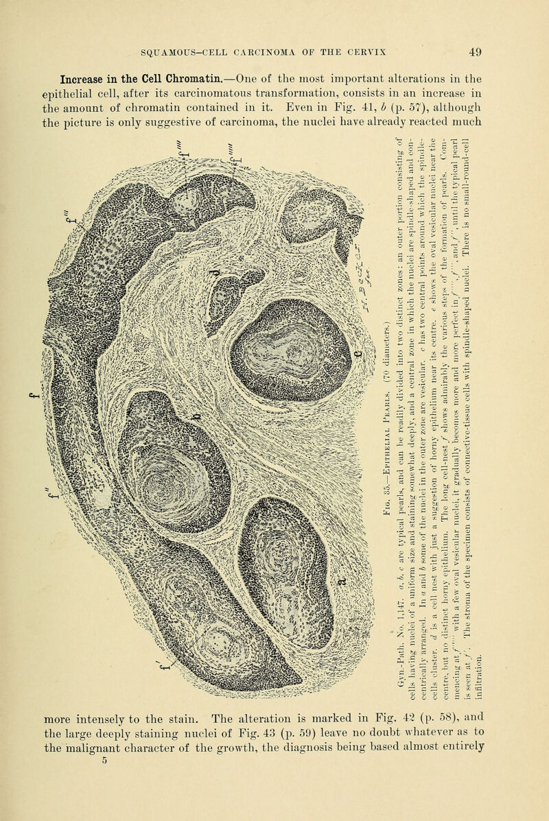 Increase in the Cell Chromatin.—One of the most important alterations in the epithelial cell, after its carcinomatous transformation, consists in an increase in the amount of chromatin contained in it. Even in Fig. 41, b (p. 57), although the picture is only suggestive of carcinoma, the nuclei have already reacted much o fl o ^ O C-. Q <2 -3 T, Ji 05 O r—1 & 3 ? 3 :' £-1 J MM 6 <? '~3 0 be ax •g| si o w bo 3 t; CD C 0 o ^ 03 ? J ^ &D <S >. -d .2 ° qT .^ c s o i^ & s oj a; O) <d ,_ c? o o o c more intensely to the stain. The alteration is marked in Fig. 42 (p. 58), and the large deeply staining nuclei of Fig. 43 (p. 59) leave no doubt whatever as to the malignant character of the growth, the diagnosis being based almost entirely 5