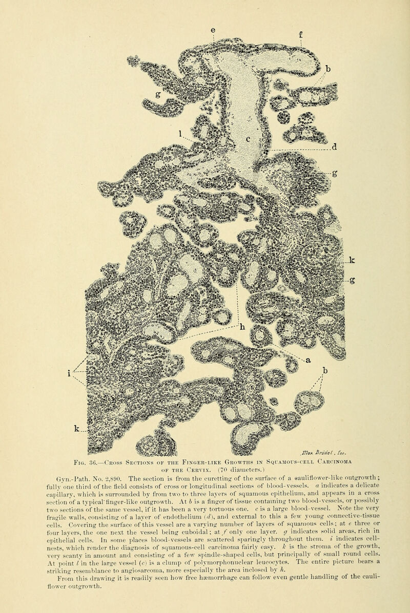 ,777cm Brode I, £ee. Fig. 36.—Ckoss Sections of the Finger-like Growths in Squamous-cell Carcinoma of the Cervix. (70 diameters.) Gyn.-Path. No. 2,890. The section is from the curetting of the surface of a eauliflower-like outgrowth; fully'one third of the field consists of cross or longitudinal sections of blood-vessels, a indicates a delicate capillary, which is surrounded by from two to three layers of squamous epithelium, and appears in a cross section of a typical*finger-like outgrowth. At b is a finger of tissue containing two blood-vessels, or possibly two sections of the same vessel, if it has been a very tortuous one. c is a large blood-vessel. Note the very fragile walls, consisting of a layer of endothelium (d), and external to this a few young connective-tissue celfs. Covering the surface of this vessel are a varying number of layers of squamous cells; at e three or four layers, the one next the vessel being cuboidal; at / only one layer, g indicates solid areas, rich in epithelial cells. In some places blood-vessels are scattered sparingly throughout them. * indicates cell- nests, which render the diagnosis of squamous-cell carcinoma fairly easy, h is the stroma of the growth, very scanty in amount and consisting of a few spindle-shaped cells, but principally of small round cells. At point I in the large vessel (c) is a clump of polymorphonuclear leucocytes. The entire picture bears a striking resemblance to angiosarcoma, more especially the area inclosed by li. From this drawing it isreadily seen how free haemorrhage can follow even gentle handling of the cauli- flower outerowth.
