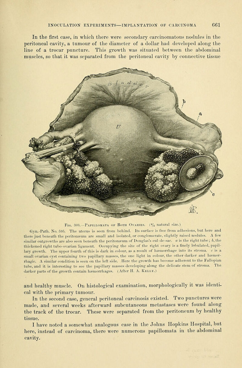 In the first case, in which there were secondary carcinomatous nodules in the peritoneal cavity, a tumour of the diameter of a dollar had developed along the line of a trocar puncture. This growth was situated between the abdominal muscles, so that it was separated from the peritoneal cavity by connective tissue Fig. 308.—Papillomata of Both Ovaries. (4/6 natural size.) Gyn.-Path. No. 595. The uterus is seen from behind. Its surface is free from adhesions, but here and there just beneath the peritonaeum are small and isolated, or conglomerate, slightly raised nodules. A few similar outgrowths are also seen beneath the peritonaeum of Douglas's cul-de-sac. a is the right tube ; 6, the thickened right tubo-ovarian ligament. Occupying the site of the right ovary is a finely lobulated, papil- lary growth. The upper fourth of this is dark in colour, as a result of haemorrhage into its stroma, c is a small ovarian cyst containing two papillary masses, the one light in colour, the other darker and hemor- rhagic. A similar condition is seen on the left side. Here the growth has become adherent to the Fallopian tube, and it is interesting to see the papillary masses developing along the delicate stem of stroma. The darker parts of the growth contain haemorrhages. (After H. A. Kelly.) and healthy muscle. On histological examination, morphologically it was identi- cal with the primary tumour. In the second case, general peritoneal carcinosis existed. Two punctures were made, and several weeks afterward subcutaneous metastases were found along the track of the trocar. These were separated from the peritoneum by healthy tissue. I have noted a somewhat analogous case in the Johns Hopkins Hospital, but here, instead of carcinoma, there were numerous papillomata in the abdominal cavity.
