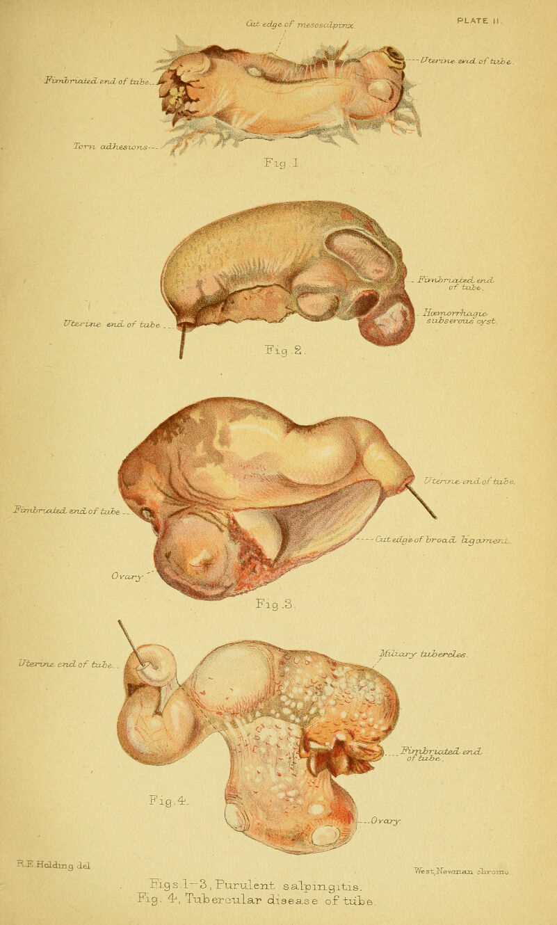 Cat edge, of mesosabpinx. Fvmbriaied. end. of tube...Jm PLATE II. ,^« Uterurve, end. of tub i. T0T77. otdheszo}-vs- Fig.l Hi Uterine end. of tube. . Fiq.2. - Fit-nhruztecL end. of tube-. Hoetnorrfoctgic' suhseroxLs cvst. Fimbriated- end. of take Uterine. enxL of tub e. ■--Cutedg'e-ofbrooUL ~bLgtxrrveri^l. Ovary' iJt&rvne. end. of tube... Fig.4. •S.Holding del Fig .3. Mfiuxry tuberoL&s. FiJTilrriatecL end. funlrr, of tub j—Ovary Fig s.1-3 , Purulent salpingitis. Fig. 41, Tubercular disea.se of tula* West, Newman duromo.