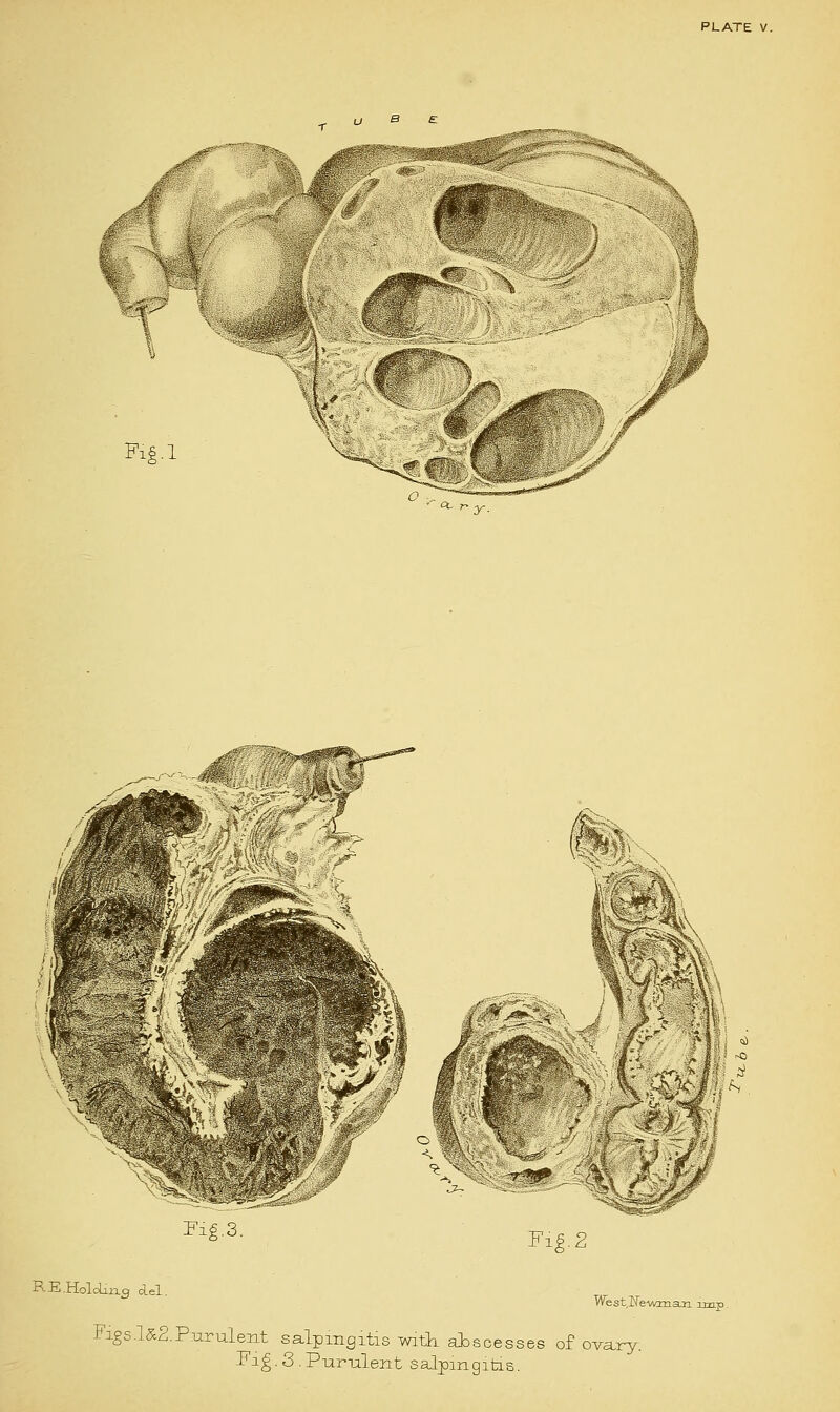 u S £ Fi£.l Fig.3. Fie. 2 RE.Holding del. WestlleiAonan unr Figs.l&2.Pnrulent salpingitis with, abscesses of ovary. Fig. 3 . Purulent salpingitis.