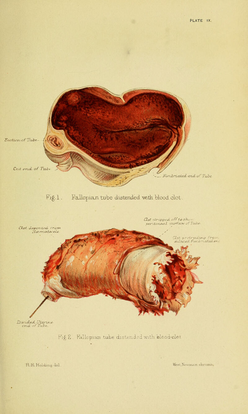 ISectiofi-of Tvvbe. Cvi e*uL of Tvub fflSfr v-— FimbriateoL end, oF Tube. Fig.l. EaUffpian tube distended mth. Hood olot. Clot de.posu.ed- rrom D wuLexL Uterwa- e.ruyL of Tube.. dot stripped off to shov. joerhton&aL surface ofTiHie-. trudkng from. Jyri.ated.eni- Fig. 2. Fallopian tube distendsdwith.lolood-clot R.E.Holding del. WesL.Xt-v/ma.Ti eliromo.