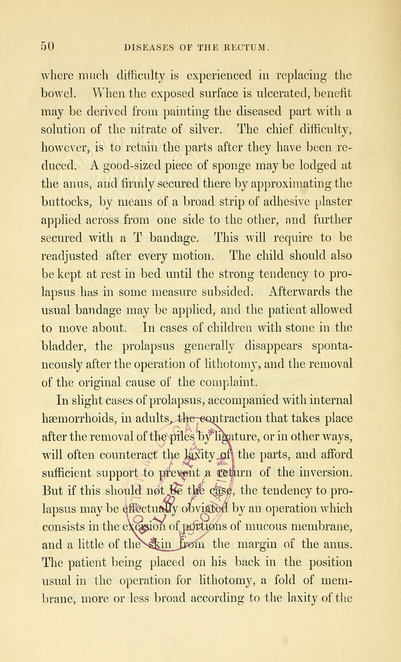 where much difficulty is experienced in replacing the bowel. When the exposed surface is ulcerated, benefit may be derived from painting the diseased part with a solution of the nitrate of silver. The chief difficulty, however, is to retain the parts after they have been re- duced. A good-sized piece of sponge may be lodged at the anus, and firmly secured there by approximating the buttocks, by means of a broad strip of adhesive plaster applied across from one side to the other, and further secured with a T bandage. This will require to be readjusted after every motion. The child should also be kept at rest in bed until the strong tendency to pro- lapsus has in some measure subsided. Afterwards the usual bandage may be applied, and the patient allowed to move about. In cases of children with stone in the bladder, the prolapsus generally disappears sponta- neously after the operation of lithotomy, and the removal of the original cause of the complaint. In slight cases of prolapsus, accompanied with internal haemorrhoids, in adults^ the~eontraction that takes place after the removal of the piles b^likature, or in other ways, will often counteract the J^ity^n the parts, and afford sufficient support to pre^it # Cfemirn of the inversion. But if this should not j?e tjie qfe/ the tendency to pro- lapsus may be effectually obviated by an operation which consists in the eWpion ofj^tiohs of mucous membrane, and a little of thes*4i[^n_3i€fni the margin of the anus. The patient being placed on his back in the position usual in the operation for lithotomy, a fold of mem- brane, more or less broad according to the laxity of the