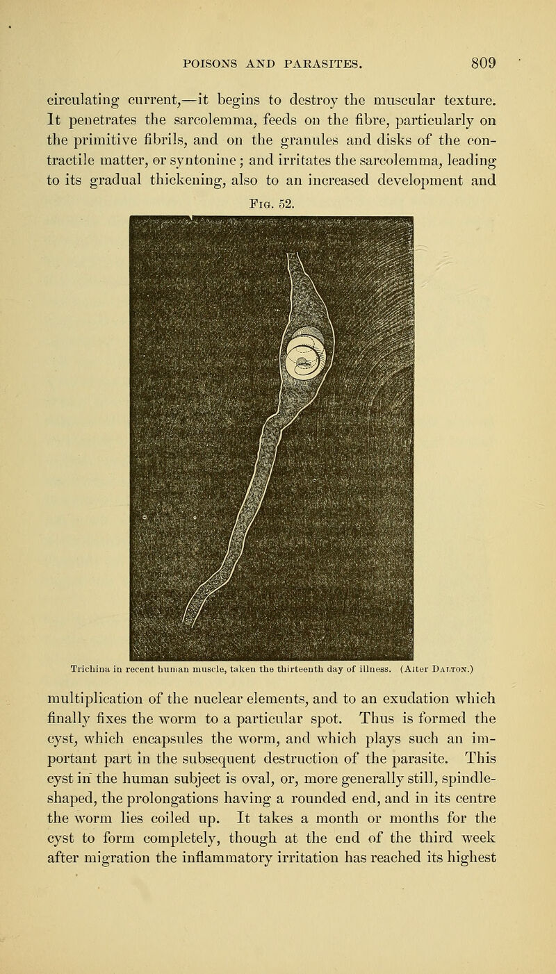 circulating current,—it begins to destroy the muscular texture. It penetrates the sarcolemma, feeds on the fibre, particularly on the primitive fibrils, and on the granules and disks of the con- tractile matter, or syntonine; and irritates the sarcolemma, leading to its gradual thickening, also to an increased development and Fig. 52. Trichina in recent human muscle, taken the thirteenth day of illness. (Alter Dalton.) multiplication of the nuclear elements, and to an exudation which finally fixes the worm to a particular spot. Thus is formed the cyst, which encapsules the worm, and which plays such an im- portant part in the subsequent destruction of the parasite. This cyst in the human subject is oval, or, more generally still, spindle- shaped, the prolongations having a rounded end, and in its centre the worm lies coiled up. It takes a month or months for the cyst to form completely, though at the end of the third week after migration the inflammatory irritation has reached its highest