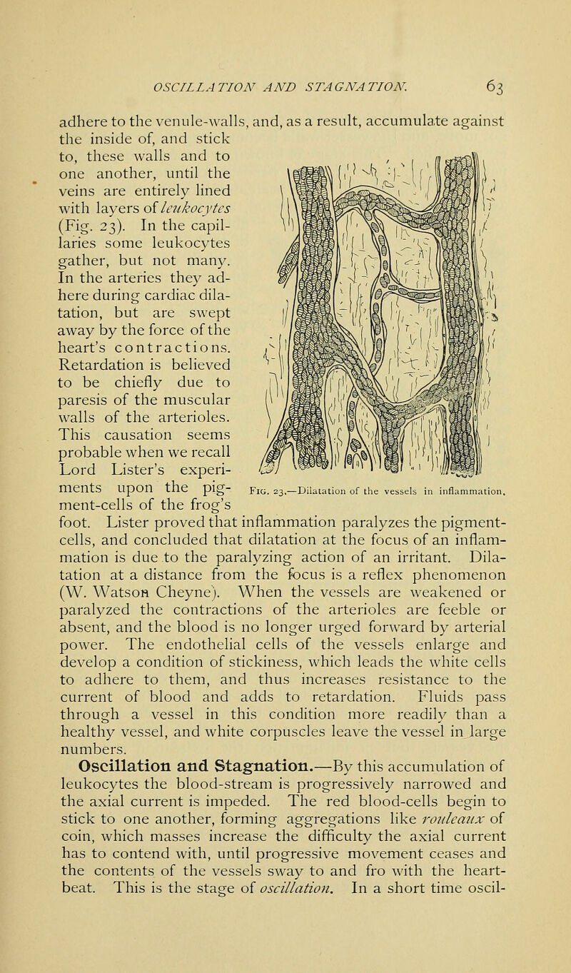 Fig. 23,—Dilatation of the vessels in inflammation. adhere to the venule-walls, and, as a result, accumulate against the inside of, and stick to, these walls and to m .^o®t one another, until the veins are entirely lined with layers of leukocytes (Fig. 23). In the capil- laries some leukocytes gather, but not many. In the arteries they ad- here during cardiac dila- tation, but are swept away by the force of the heart's contractions. Retardation is believed to be chiefly due to paresis of the muscular walls of the arterioles. This causation seems probable when we recall Lord Lister's experi- ments upon the pig- ment-cells of the frog's foot. Lister proved that inflammation paralyzes the pigment- cells, and concluded that dilatation at the focus of an inflam- mation is due to the paralyzing action of an irritant. Dila- tation at a distance from the focus is a reflex phenomenon (W. Watson Cheyne). When the vessels are weakened or paralyzed the contractions of the arterioles are feeble or absent, and the blood is no longer urged forward by arterial power. The endothelial cells of the vessels enlarge and develop a condition of stickiness, which leads the white cells to adhere to them, and thus increases resistance to the current of blood and adds to retardation. Fluids pass through a vessel in this condition more readily than a healthy vessel, and white corpuscles leave the vessel in large numbers. Oscillation and Stagnation.—By this accumulation of leukocytes the blood-stream is progressively narrowed and the axial current is impeded. The red blood-cells begin to stick to one another, forming aggregations like rouleaux of coin, which masses increase the difficulty the axial current has to contend with, until progressive movement ceases and the contents of the vessels sway to and fro with the heart- beat. This is the stage of oscillation. In a short time oscil-