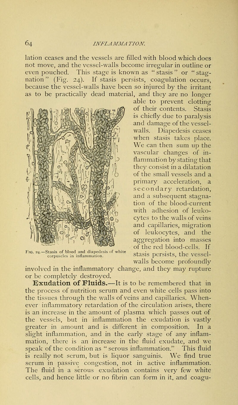 lation ceases and the vessels are filled with blood which does not move, and the vessel-walls become irregular in outline or even pouched. This stage is known as  stasis  or  stag- nation  (Fig. 24). If stasis persists, coagulation occurs, because the vessel-walls have been so injured by the irritant as to be practically dead material, and they are no longer able to prevent clotting of their contents. Stasis is chiefly due to paralysis and damage of the vessel- walls. Diapedesis ceases when stasis takes place. We can then sum up the vascular changes of in- flammation by stating that they consist in a dilatation of the small vessels and a primary acceleration, a secondary retardation, and a subsequent stagna- tion of the blood-current with adhesion of leuko- cytes to the walls of veins and capillaries, migration of leukocytes, and the aggregation into masses of the red blood-cells. If stasis persists, the vessel- walls become profoundly involved in the inflammatory change, and they may rupture or be completely destroyed. Exudation of Fluids.—It is to be remembered that in the process of nutrition serum and even white cells pass into the tissues through the walls of veins and capillaries. When- ever inflammatory retardation of the circulation arises, there is an increase in the amount of plasma which passes out of the vessels, but in inflammation the exudation is vastly greater in amount and is different in composition. In a slight inflammation, and in the early stage of any inflam- mation, there is an increase in the fluid exudate, and we speak of the condition as  serous inflammation. This fluid is really not serum, but is liquor sanguinis. We find true serum in passive congestion, not in active inflammation. The fluid in a serous exudation contains very few white cells, and hence little or no fibrin can form in it, and coagu- Fig. 24.—Stasis of blood and diapedesis of white corpuscles in inflammation.