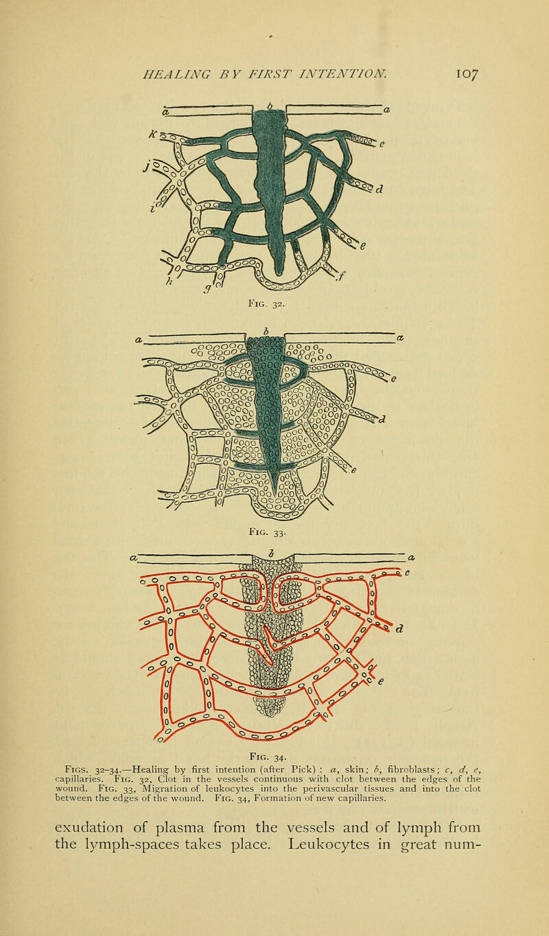 Fig. 34. Figs. 32-34.—Healing by first intention (after Pick) : a, skin; b, fibroblasts; c, d, e, capillaries. Fig. 32, Clot in the vessels continuous with clot between the edges of the wound. Fig. 33, Migration of leukocytes into the perivascular tissues and into the clot between the edges of the wound. Fig. 34, Formation of new capillaries. exudation of plasma from the vessels and of lymph from the lymph-spaces takes place. Leukocytes in great num-
