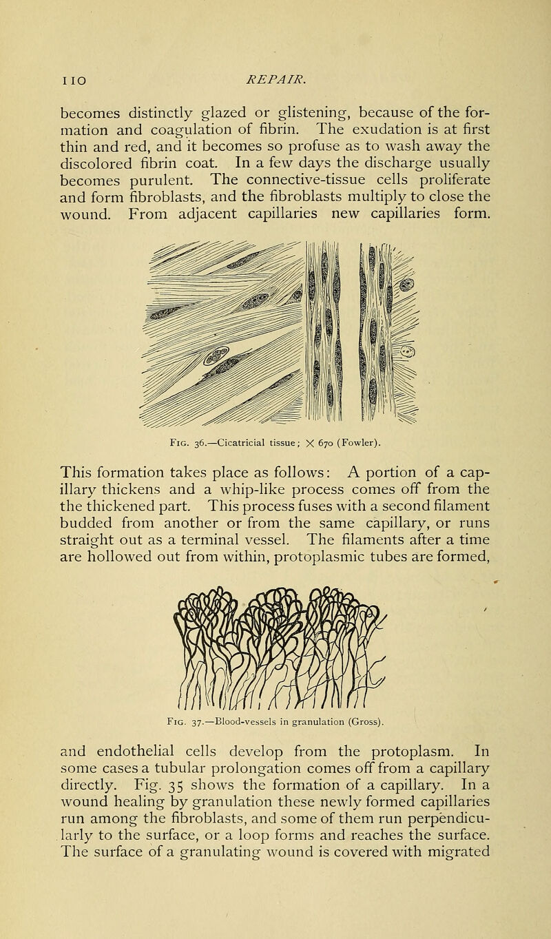 becomes distinctly glazed or glistening, because of the for- mation and coagulation of fibrin. The exudation is at first thin and red, and it becomes so profuse as to wash away the discolored fibrin coat. In a few days the discharge usually becomes purulent. The connective-tissue cells proliferate and form fibroblasts, and the fibroblasts multiply to close the wound. From adjacent capillaries new capillaries form. Fig. 36.—Cicatricial tissue; X 670 (Fowler). This formation takes place as follows: A portion of a cap- illary thickens and a whip-like process comes off from the the thickened part. This process fuses with a second filament budded from another or from the same capillary, or runs straight out as a terminal vessel. The filaments after a time are hollowed out from within, protoplasmic tubes are formed, Fig. 37.—Blood-vessels in granulation (Gross). and endothelial cells develop from the protoplasm. In some cases a tubular prolongation comes off from a capillary directly. Fig. 35 shows the formation of a capillary. In a wound healing by granulation these newly formed capillaries run among the fibroblasts, and some of them run perpendicu- . larly to the surface, or a loop forms and reaches the surface. The surface of a granulating wound is covered with migrated