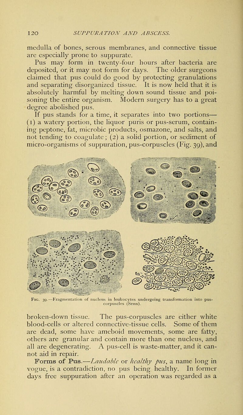 medulla of bones, serous membranes, and connective tissue are especially prone to suppurate. Pus may form in twenty-four hours after bacteria are deposited, or it may not form for days. The older surgeons claimed that pus could do good by protecting granulations and separating disorganized tissue. It is now held that it is absolutely harmful by melting down sound tissue and poi- soning the entire organism. Modern surgery has to a great degree abolished pus. If pus stands for a time, it separates into two portions— (i) a watery portion, the liquor puris or pus-serum, contain- ing peptone, fat, microbic products, osmazone, and salts, and not tending to coagulate; (2) a solid portion, or sediment of micro-organisms of suppuration, pus-corpuscles (Fig. 39), and Fig. 39.—Fragmentation of nucleus in leukocytes undergoing transformation into pus- corpuscles (Senn). broken-down tissue. The pus-corpuscles are either white blood-cells or altered connective-tissue cells. Some of them are dead, some have ameboid movements, some are fatty, others are granular and contain more than one nucleus, and all are degenerating. A pus-cell is waste-matter, and it can- not aid in repair. Forms of Pus.—Laudable or healthy pus, a name long in vogue, is a contradiction, no pus being healthy. In former days free suppuration after an operation was regarded as a