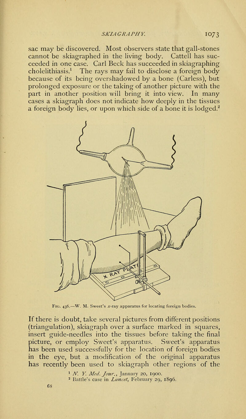 SKIAGRAPHY. IO73 sac may be discovered. Most observers state that gall-stones cannot be skiagraphed in the living body. Cattell has suc- ceeded in one case. Carl Beck has succeeded in skiagraphing cholelithiasis.1 The rays may fail to disclose a foreign body because of its being overshadowed by a bone (Carless), but prolonged exposure or the taking of another picture with the part in another position will bring it into view. In many cases a skiagraph does not indicate how deeply in the tissues a foreign body lies, or upon which side of a bone it is lodged.2 Fig. 436.—W. M. Sweet's jr-ray apparatus for locating foreign bodies. If there is doubt, take several pictures from different positions (triangulation), skiagraph over a surface marked in squares, insert guide-needles into the tissues before taking the final picture, or employ Sweet's apparatus. Sweet's apparatus has been used successfully for the location of foreign bodies in the eye, but a modification of the original apparatus has recently been used to skiagraph other regions of the 1 N. Y. Med. Jour., January 20, 1900.