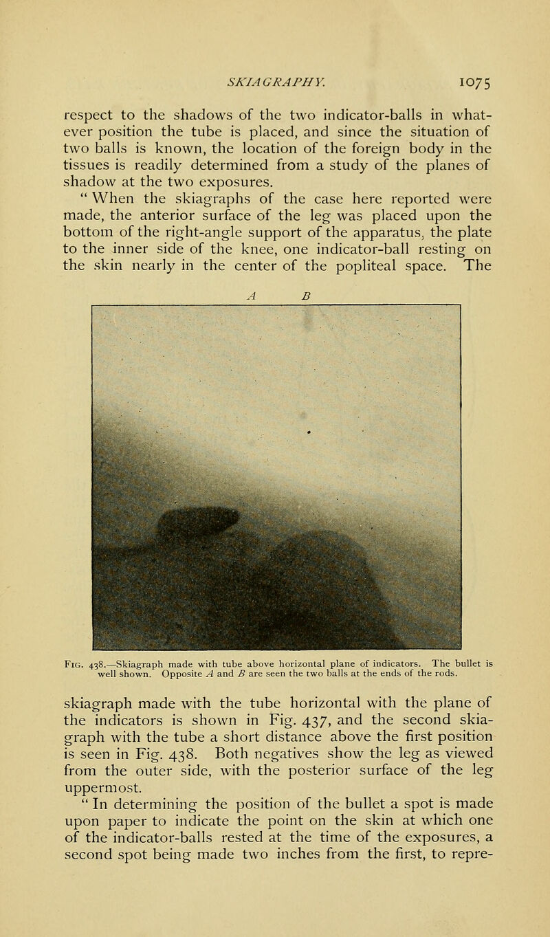 respect to the shadows of the two indicator-balls in what- ever position the tube is placed, and since the situation of two balls is known, the location of the foreign body in the tissues is readily determined from a study of the planes of shadow at the two exposures.  When the skiagraphs of the case here reported were made, the anterior surface of the leg was placed upon the bottom of the right-angle support of the apparatus, the plate to the inner side of the knee, one indicator-ball resting on the skin nearly in the center of the popliteal space. The Fig. 438.—Skiagraph made with tube above horizontal plane of indicators. The bullet is well shown. Opposite A and B axe seen the two balls at the ends of the rods. skiagraph made with the tube horizontal with the plane of the indicators is shown in Fig. 437, and the second skia- graph with the tube a short distance above the first position is seen in Fig. 438. Both negatives show the leg as viewed from the outer side, with the posterior surface of the leg uppermost.  In determining the position of the bullet a spot is made upon paper to indicate the point on the skin at which one of the indicator-balls rested at the time of the exposures, a second spot being made two inches from the first, to repre-