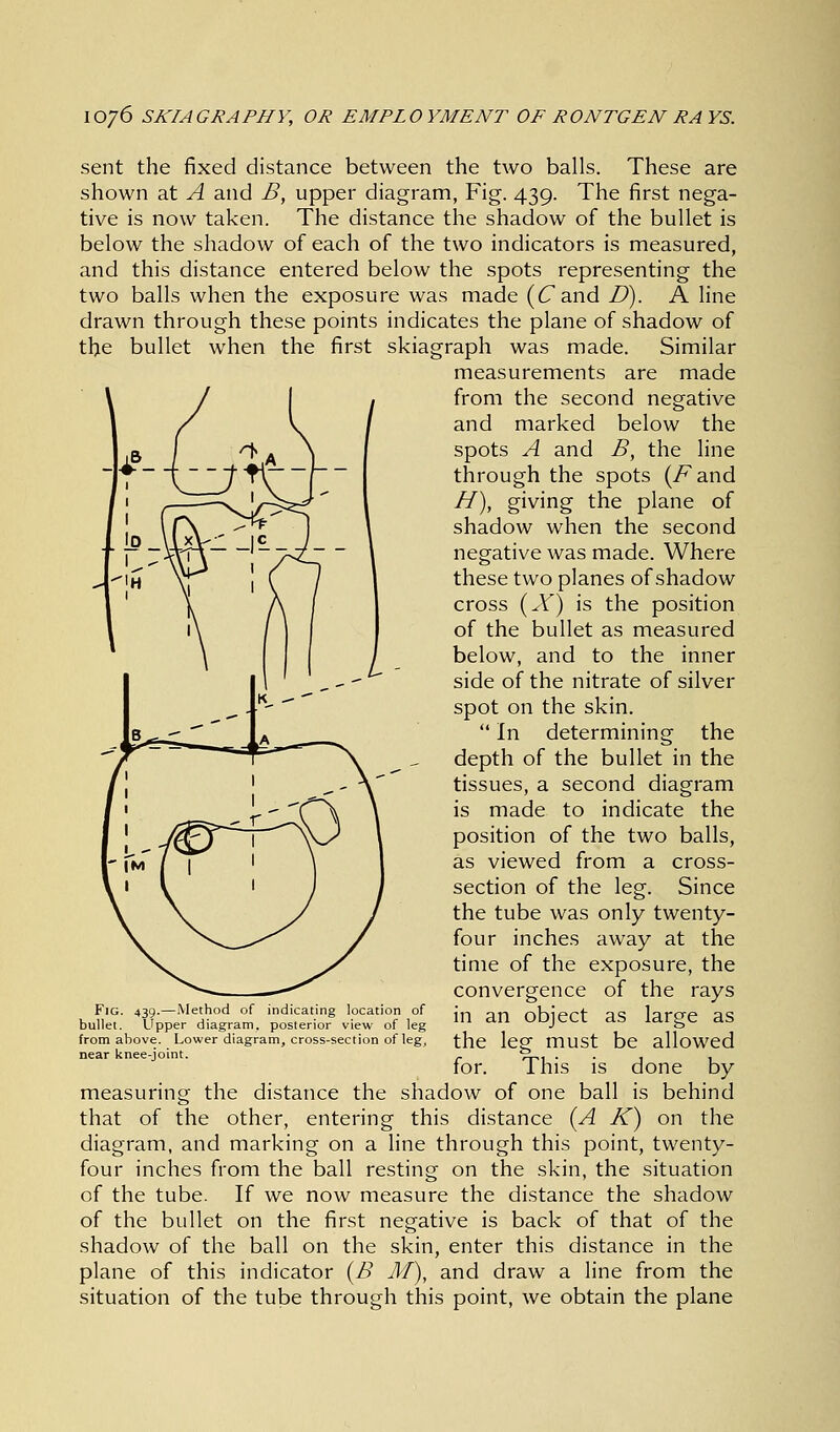 sent the fixed distance between the two balls. These are shown at A and B, upper diagram, Fig. 439. The first nega- tive is now taken. The distance the shadow of the bullet is below the shadow of each of the two indicators is measured, and this distance entered below the spots representing the two balls when the exposure was made (£7 and D). A line drawn through these points indicates the plane of shadow of the bullet when the first skiagraph was made. Similar measurements are made from the second negative and marked below the spots A and B, the line through the spots (/^and H), giving the plane of shadow when the second negative was made. Where these two planes of shadow cross (X) is the position of the bullet as measured below, and to the inner side of the nitrate of silver spot on the skin.  In determining the depth of the bullet in the tissues, a second diagram is made to indicate the position of the two balls, as viewed from a cross- section of the leg. Since the tube was only twenty- four inches away at the time of the exposure, the convergence of the rays in an object as large as the leg must be allowed for. This is done by measuring the distance the shadow of one ball is behind that of the other, entering this distance {A K) on the diagram, and marking on a line through this point, twenty- four inches from the ball resting on the skin, the situation of the tube. If we now measure the distance the shadow of the bullet on the first negative is back of that of the shadow of the ball on the skin, enter this distance in the plane of this indicator (B M), and draw a line from the situation of the tube through this point, we obtain the plane Fig. 439.—Method of indicating location of bullet. Upper diagram, posterior view of leg from above. Lower diagram, cross-section of leg, near knee-joint.