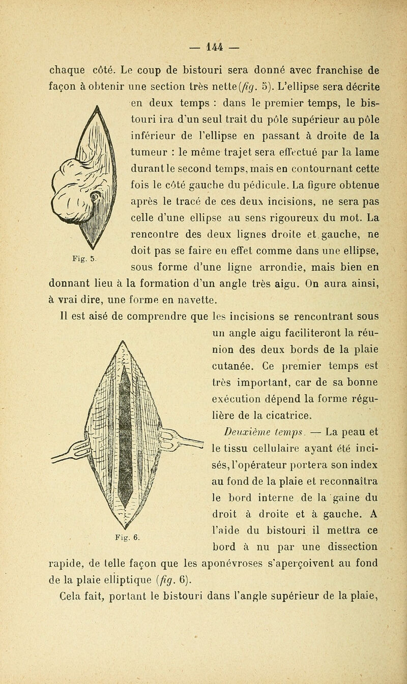 Fig. 5. chaque côté. Le coup de bistouri sera donné avec franchise de façon à obtenir une section très nette [fig. 5). L'ellipse sera décrite en deux temps : dans le premier temps, le bis- touri ira d'un seul trait du pôle supérieur au pôle inférieur de l'ellipse en passant à droite de la tumeur : le même trajet sera effectué par la lame durant le second temps, mais en contournant cette fois le côté gauche du pédicule. La figure obtenue après le tracé de ces deux incisions, ne sera pas celle d'une ellipse au sens rigoureux du mot. La rencontre des deux lignes droite et gauche, ne doit pas se faire eti effet comme dans une ellipse, sous forme d'une ligne arrondie, mais bien en donnant lieu à la formation d'un angle très aigu. On aura ainsi, à vrai dire, une forme en navette. Il est aisé de comprendre que les incisions se rencontrant sous un angle aigu faciliteront la réu- nion des deux bords de la plaie cutanée. Ce premier temps est très important, car de sa bonne exécution dépend la forme régu- lière de la cicatrice. Deuxième temps. — La peau et le tissu cellulaire ayant été inci- sés, l'opérateur portera son index au fond de la plaie et reconnaîtra le bord interne de la gaine du droit à droite et à gauche. A l'aide du bistouri il mettra ce bord à nu par une dissection rapide, de telle façon que les aponévroses s'aperçoivent au fond de la plaie elliptique (fig. 6). Cela fait, portant le bistouri dans l'angle supérieur de la plaie,
