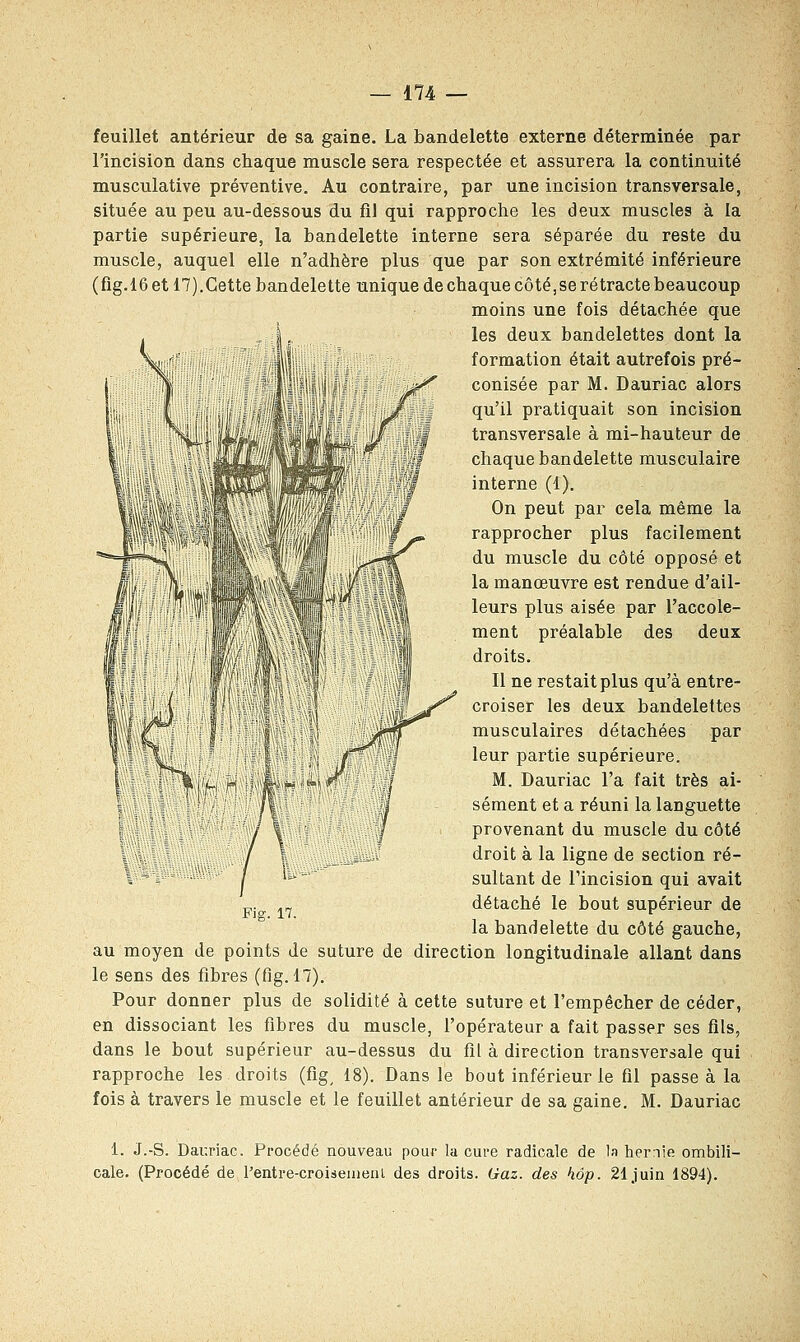 !il\! feuillet antérieur de sa gaine. La bandelette externe déterminée par l'incision dans chaque muscle sera respectée et assurera la continuité musculative préventive. Au contraire, par une incision transversale, située au peu au-dessous du fil qui rapproche les deux muscles à la partie supérieure, la bandelette interne sera séparée du reste du muscle, auquel elle n'adhère plus que par son extrémité inférieure (fig.16 et 17).Cette bandelette unique de chaque côté,se rétracte beaucoup moins une fois détachée que . , !. les deux bandelettes dont la formation était autrefois pré- conisée par M. Dauriac alors qu'il pratiquait son incision transversale à mi-hauteur de chaque bandelette musculaire interne (1). On peut par cela même la rapprocher plus facilement du muscle du côté opposé et la manœuvre est rendue d'ail- leurs plus aisée par l'accole- ment préalable des deux droits. Il ne restait plus qu'à entre- croiser les deux bandelettes musculaires détachées par leur partie supérieure. M. Dauriac l'a fait très ai- sément et a réuni la languette provenant du muscle du côté droit à la ligne de section ré- sultant de l'incision qui avait détaché le bout supérieur de la bandelette du côté gauche, au moyen de points de suture de direction longitudinale allant dans le sens des fibres (fig. 17). Pour donner plus de solidité à cette suture et l'empêcher de céder, en dissociant les fibres du muscle, l'opérateur a fait passer ses fils, dans le bout supérieur au-dessus du fil à direction transversale qui rapproche les droits (fig, 18). Dans le bout inférieur le fil passe à la fois à travers le muscle et le feuillet antérieur de sa gaine. M. Dauriac // Fig. 17. 1. J.-S. Dauriac. Procédé nouveau pour la cure radicale de la hernie ombili- cale. (Procédé de l'entre-croiseinenl des droits. Gaz. des hop. 21 juin 1894).