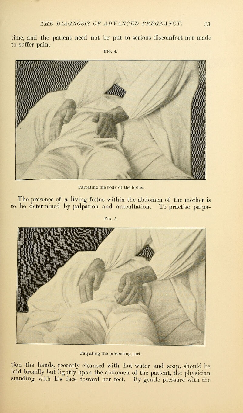 time, and the patient need not be put to serious discomfort nor made to suffer pain. Fig. 4. Palpating the body of the fcetus. The presence of a living foetus within the abdomen of the mother is to be determined by palpation and auscultation. To practise palpa- Fig. 5. Palpating the presenting part. tion the hands, recently cleansed with hot water and soap, should be laid broadly but lightly upon the abdomen of the patient, the physician standing with his face toward her feet. By gentle pressure with the