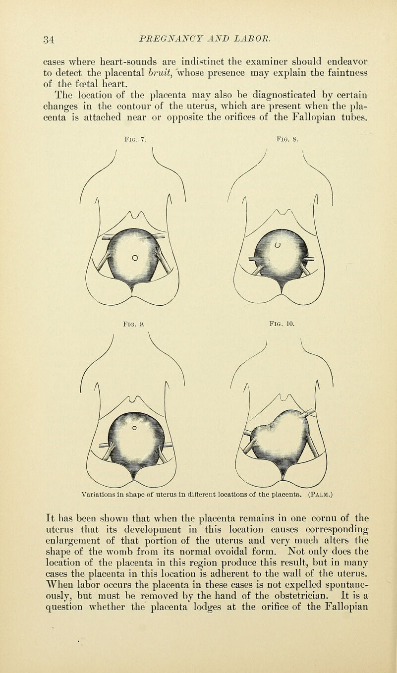 cases where heart-sounds are indistinct the examiner should endeavor to detect the placental bruit, whose presence may explain the faintness of the foetal heart. The location of the placenta may also be diagnosticated by certain changes in the contour of the uterus, which are present when the pla- centa is attached near or opposite the orifices of the Fallopian tubes. Fig. 7. Fig. 8. Fig. 10. Variations in shape of uterus in different locations of the placenta. (Palm.) It has been shown that when the placenta remains in one corou of the uterus that its development in this location causes corresponding enlargement of that portion of the uterus and very much alters the shape of the womb from its normal ovoidal form. Not only does the location of the placenta in this region produce this result, but in many cases the placenta in this location is adherent to the wall of the uterus. When labor occurs the placenta in these cases is not expelled spontane- ously, but must be removed by the hand of the obstetrician. It is a question whether the placenta lodges at the orifice of the Fallopian