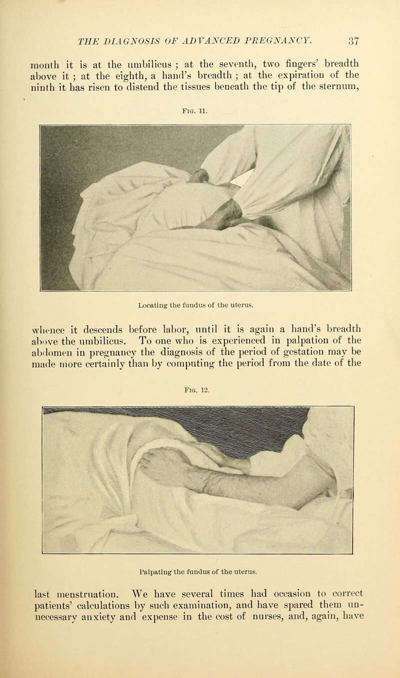 month it is at the umbilicus ; at the seventh, two fingers' breadth above it ; at the eighth, a hand's breadth ; at the expiration of the ninth it has risen to distend the tissues beneath the tip of the sternum, Fig. 11. Locating the fundus of the uterus. whence it descends before labor, until it is again a hand's breadth above the umbilicus. To one who is experienced in palpation of the abdomen in pregnancy the diagnosis of the period of gestation may be made more certainly than by computing the period from the date of the Fig. 12. Palpating the fundus of the uterus. last menstruation. We have several times had occasion to correct patients' calculations by such examination, and have spared them un- necessary anxiety and expense in the cost of nurses, and, again, have