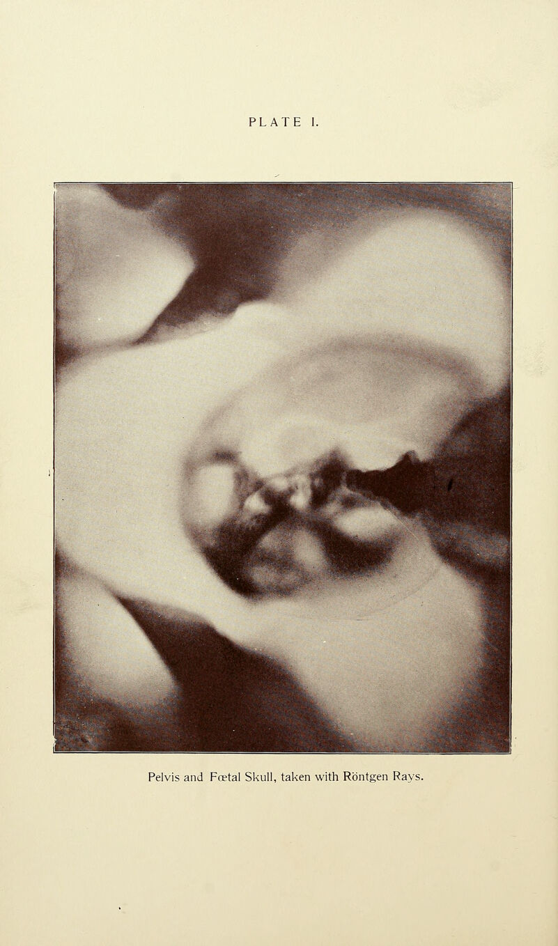 Pelvis and Foetal Skull, taken with Rbntgen Rays.