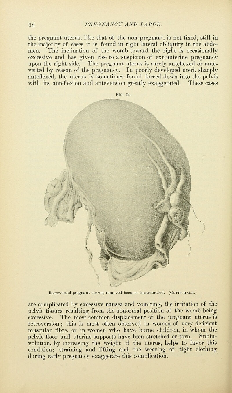the pregnant uterus, like that of the nou-pregnaut, is not fixed, still in the majority of cases it is found in right lateral obliquity iu the abdo- men. The inclination of the womb toward the right is occasionally excessive and has given rise to a suspicion of extrauterine pregnancy upon the right side. The pregnant uterus is rarely anteflexed or ante- verted by reason of the pregnancy. In poorly developed uteri, sharply anteflexed, the uterus is sometimes found forced down into the pelvis with its anteflexion and anteversion greatly exaggerated. These cases Fig. 42. Retroverted pregnant uterus, removed because incarcerated. (Gottschalk.) are complicated by excessive nausea and vomiting, the irritation of the pelvic tissues resulting from the abnormal position of the womb being excessive. The most common displacement of the pregnant uterus is retroversion ; this is most often observed in women of very deficient muscular fibre, or in women who have borne children, in whom the pelvic floor and uterine supports have been stretched or torn. Subin- volution, by increasing the weight of the uterus, helps to favor this condition; straining and lifting and the wearing of tight clothing during early pregnancy exaggerate this complication.