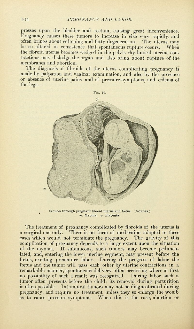 presses upon the bladder and rectum, causing great inconvenience. Pregnancy causes these tumors to increase iu size very rapidly, and often brings about softening and fatty degeneration. The uterus may be so altered in consistence that spontaneous rupture occurs. When the fibroid uterus becomes wedged in the pelvis rhythmical uterine con- tractions may dislodge the organ and also bring about rupture of the membranes and abortion. The diagnosis of fibroids of the uterus complicating pregnancy is made by palpation and vaginal examination, and also by the presence or absence of uterine pains and of pressure-symptoms, and oedema of the legs. Section through pregnant fibroid uterus and foetus. (Gordes.) m. Myoma, p. Placenta. The treatment of pregnancy complicated by fibroids of the uterus is a surgical one only. There is no form of medication adapted to these cases which would not terminate the pregnancy. The gravity of this complication of pregnancy depends to a large extent upon the situation of the myoma. If submucous, such tumors may become peduncu- lated, and, entering the lower uterine segment, may present before the foetus, exciting premature labor. During the progress of labor the foetus and the tumor will pass each other by uterine contractions in a remarkable manner, spontaneous delivery often occurring where at first no possibility of such a result was recognized. During labor such a tumor often presents before the child; its removal during parturition is often possible. Intramural tumors may not be diagnosticated during pregnancy, and require no treatment unless they so enlarge the womb as to cause pressure-symptoms. When this is the case, abortion or