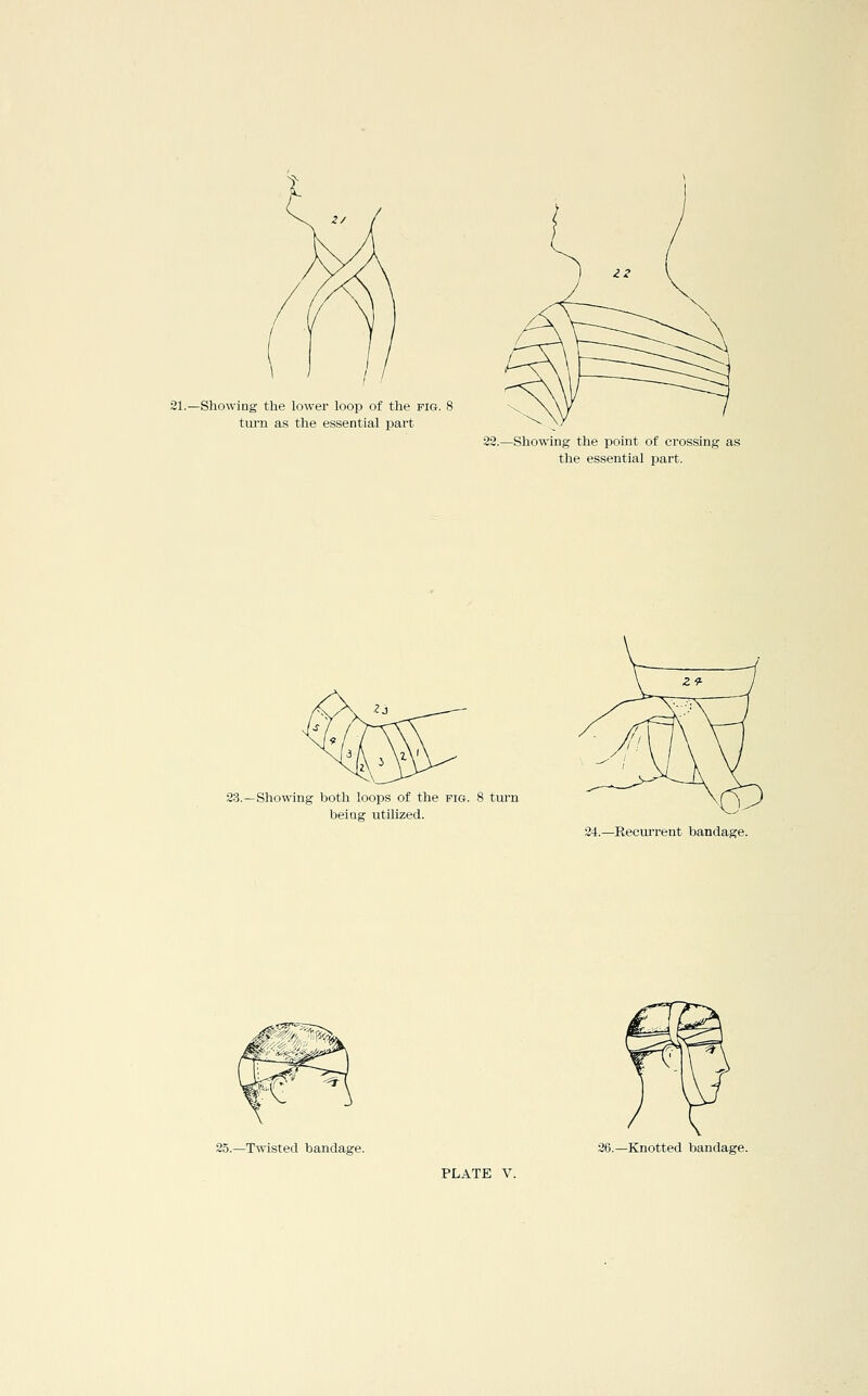 21.—Showing the lower loop of the pig. 8 turn as the essential part 23.—Showing the point of crossing as the essential part. 23.—Showing both loops of the fig. 8 tm-n being utilized. 24.—Recurrent bandage. 25.—Twisted bandage. 26.—Knotted bandage.