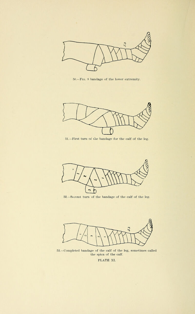 o 51.—First turn or ilie bandage for the calf of the leg. 52.—Second turn of the bandage of the calf of the leg. 53.—Completed bandage of the calf of the leg, sometimes called the spica of the calf.