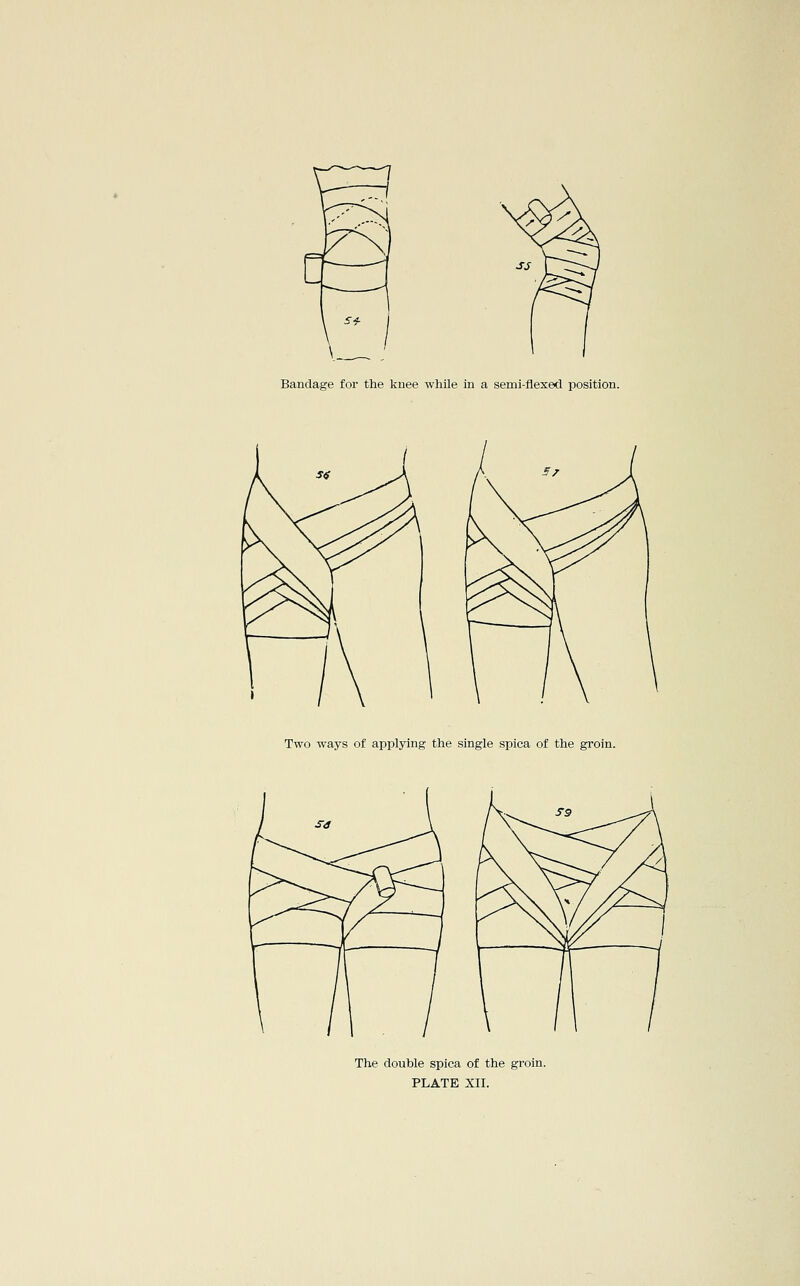 Bandage for the kuee while in a semi-flexed position. Two ways of applying the single spica of the groin. The double spica of the groin.