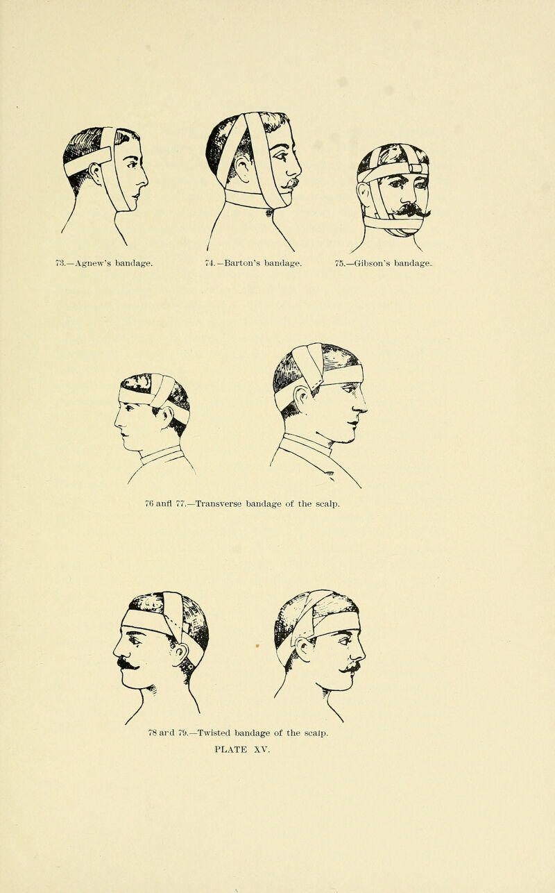 rS.—Agnew's bandage. r4.—Barton's bandage. 75.—Gibson's bandage. 76 anfl 77.—Transvei'se bandage of the scalp. 78 ard 79.—Twisted bandage of the scalp. PLATE XV.