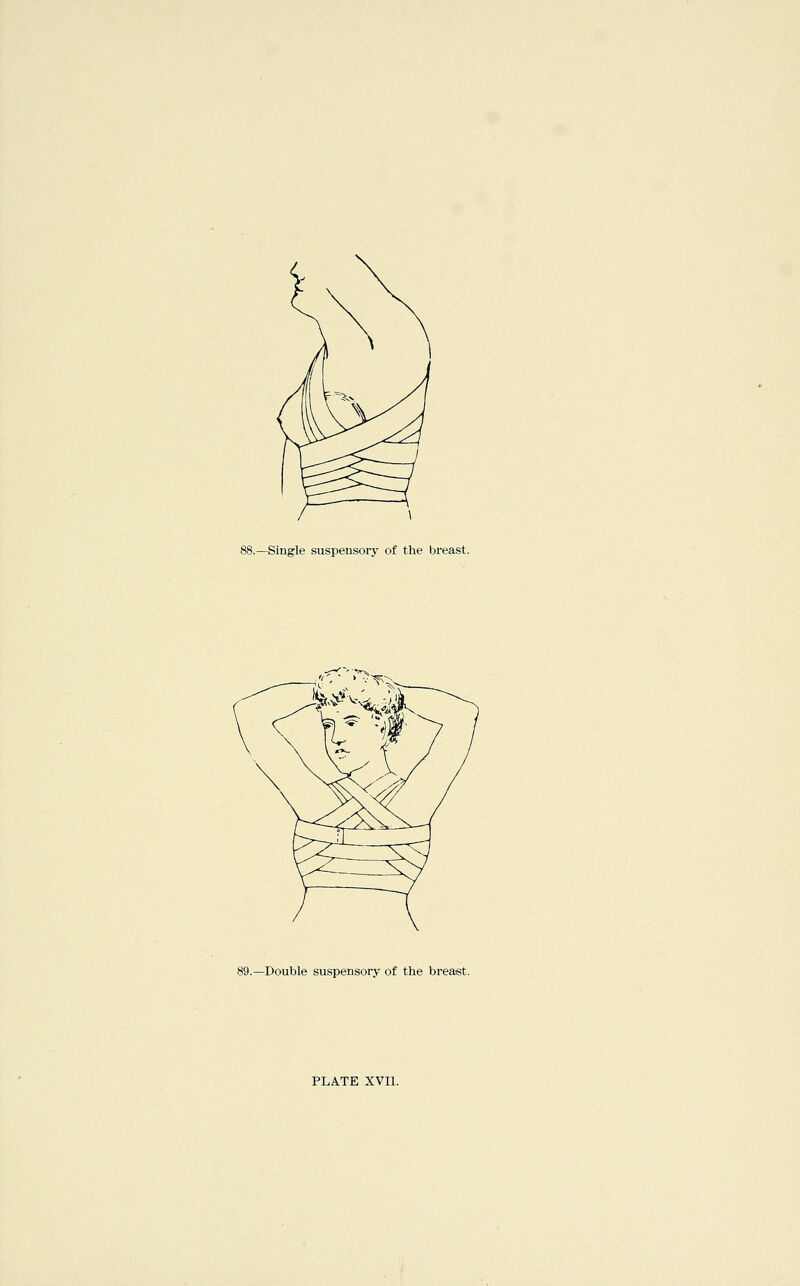 -Single suspensory of the breast. -Double suspensory of the breast.