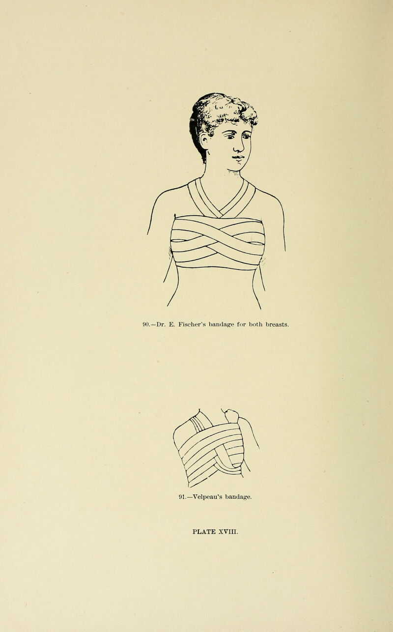 90.—Dr. E. Fischer's bandage for both breasts. 91.—Velpeau's bandage.