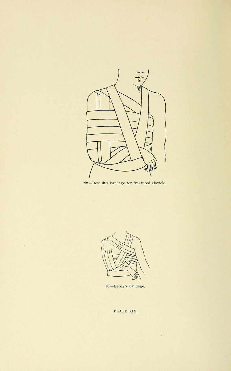 $2.—Desault's bandage for fractured clavicle. 93.—Gerdy's bandage.