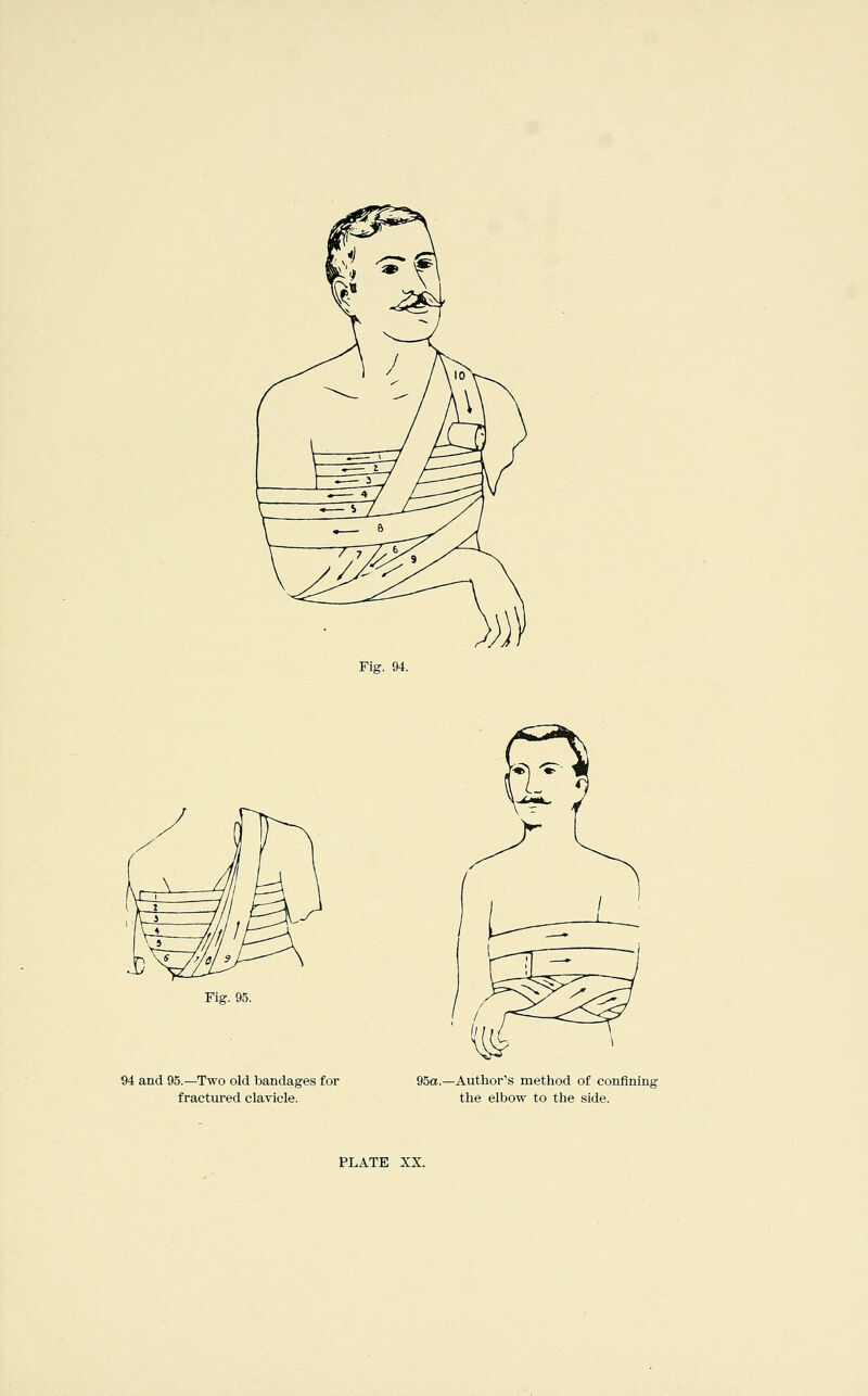 Fig. 94. Fig. 95. 94 and 95.—Two old bandages for fractured clavicle. 95a.—Author's method of confining the elbow to the side.