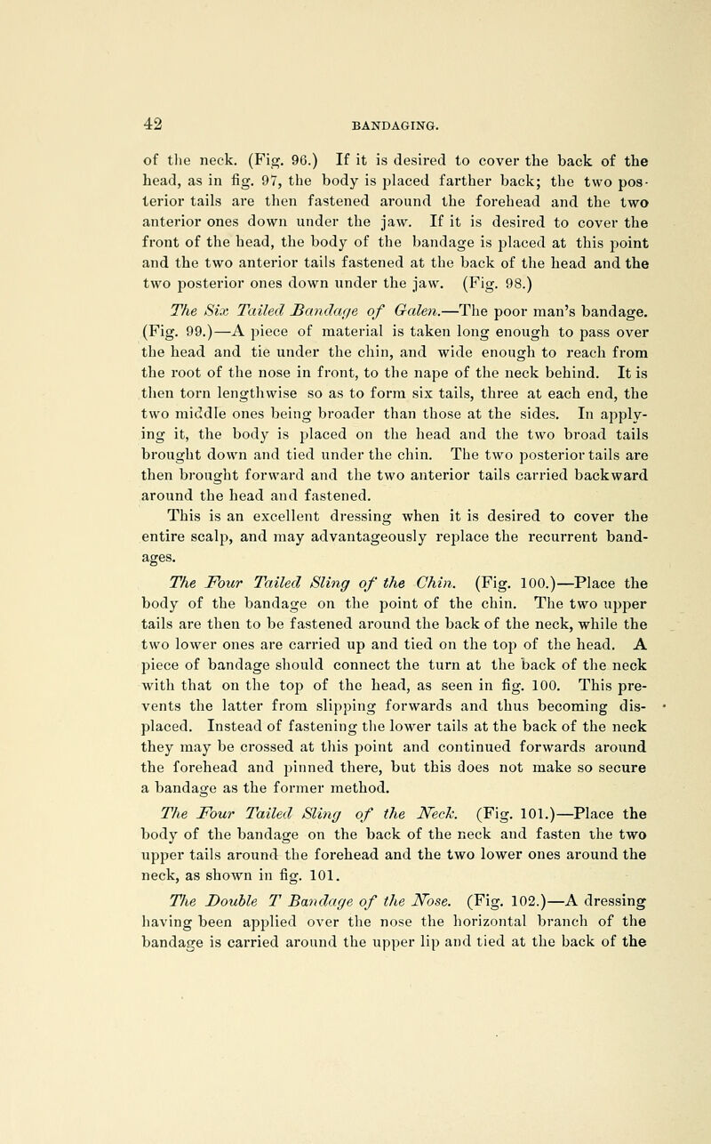 of tlie neck. (Fig. 96.) If it is desired to cover the back of the head, as in fig. 97, the body is placed farther back; the two pos- terior tails are then fastened around the forehead and the two anterior ones down under the jaw. If it is desired to cover the front of the head, the body of the bandage is placed at this point and the two anterior tails fastened at the back of the head and the two posterior ones down under the jaw. (Fig. 98.) The Six Tailed Bandage of Galen.—The poor man's bandage. (Fig. 99.)—A piece of material is taken long enough to pass over the head and tie under the chin, and wide enough to reach from the root of the nose in front, to the nape of the neck behind. It is then torn lengthwise so as to form six tails, three at each end, the two middle ones being broader than those at the sides. In apply- ing it, the body is placed on the head and the two bi'oad tails brought down and tied under the chin. The two posterior tails are then brought forward and the two anterior tails carried backward around the head and fastened. This is an excellent dressing when it is desired to cover the entire scalp, and may advantageously replace the recurrent band- ages. The Four Tailed Sling of the Chin. (Fig, 100.)—Place the body of the bandage on the point of the chin. The two upper tails are then to be fastened around the back of the neck, while the two lower ones are cari'ied up and tied on the top of the head. A piece of bandage should connect the turn at the back of the neck with that on the top of the head, as seen in fig. 100. This pre- vents the latter from slipping forwards and thus becoming dis- placed. Instead of fastening the lower tails at the back of the neck they may be crossed at this point and continued forwai'ds ai'ound the forehead and pinned there, but this does not make so secure a bandage as the former method. The Four Tailed Slitig of the JSTeck. (Fig. 101.)—Place the body of the bandage on the back of the neck and fasten the two upper tails around the forehead and the two lower ones around the neck, as shown in fig. 101. The Double T Bandage of the Kose. (Fig. 102.)—A dressing having been applied over the nose the horizontal branch of the bandage is carried around the upper lip and tied at the back of the