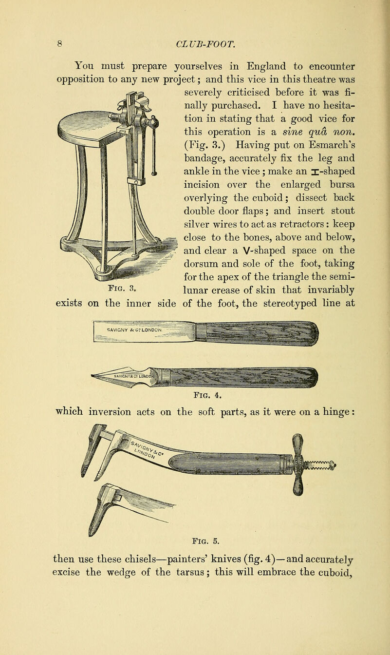 You must prepare yourselves in England to encounter opposition to any new project; and this vice in this theatre was severely criticised before it was fi- nally purchased. I have no hesita- tion in stating that a good vice for this operation is a sine qua non. (Fig. 3.) Having put on Esmarch's bandage, accurately fix the leg and ankle in the vice; make an i-shaped incision over the enlarged bursa overlying the cuboid; dissect back double door flaps; and insert stout silver wires to act as retractors: keep close to the bones, above and below, and clear a V-shaped space on the dorsum and sole of the foot, taking for the apex of the triangle the semi- ^i<^- 3- lunar crease of skin that invariably exists on the inner side of the foot, the stereotyped line at Fig. 4. which inversion acts on the soft parts, as it were on a hinge Fig. 5. then use these chisels—painters' knives (fig. 4)—and accurately excise the wedge of the tarsus; this will embrace the cuboid.