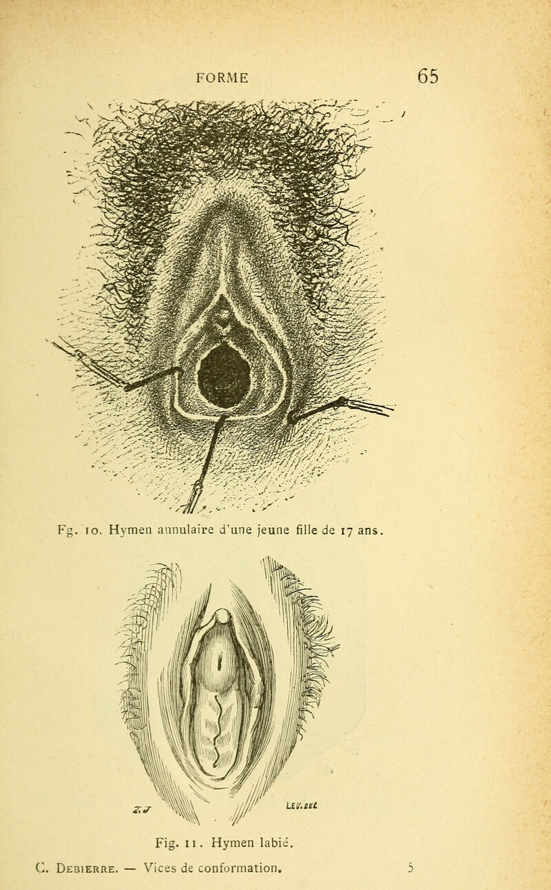 Fg/io. Hymen annulaire d'une jeune fille de 17 ans. Fig. 11. Hymen labié. C. Debierre. — Vices de conformation.