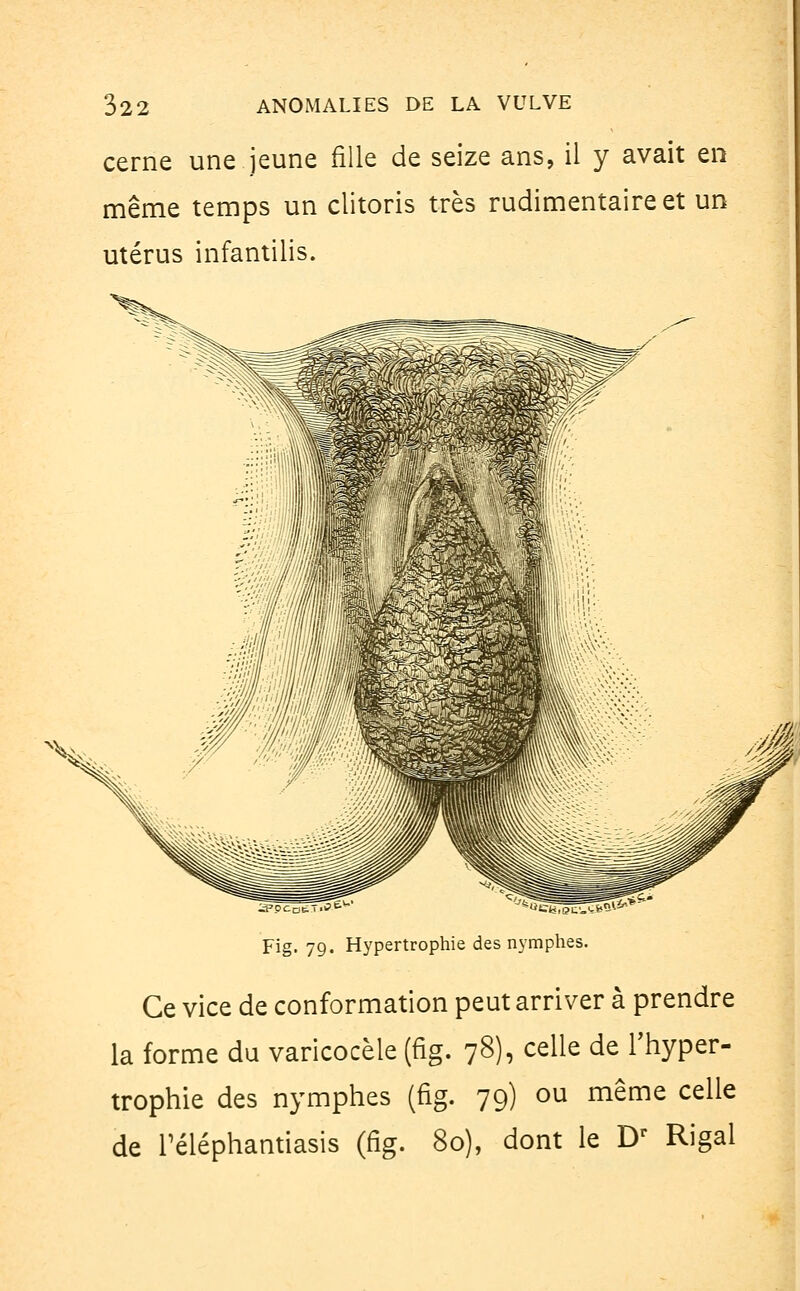 cerne une jeune fille de seize ans, il y avait en même temps un clitoris très rudimentaireet un utérus infantilis. Fig. 79. Hypertrophie des nymphes. Ce vice de conformation peut arriver à prendre la forme du varicocèle (fig. 78), celle de l'hyper- trophie des nymphes (fig. 79) ou même celle de réléphantiasis (fig. 80), dont le Dr Rigal