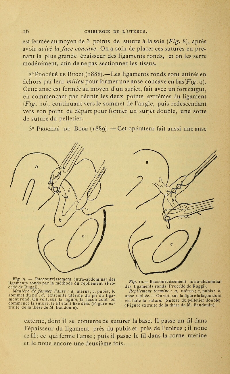 est fermée au moyen de 3 points de suture à la soie {Fig. 8), après avoir avivé la face concave. On a soin de placer ces sutures en pre- nant la plus grande épaisseur des ligaments ronds, et on les serre modérément, afin de ne pas sectionner les tissus. 2° Procédé de Ruggi (1888).—Les ligaments ronds sont attirés en dehors parleur milieu pour former une anse concave en ba.s{Fig. 9). Cette anse est fermée au moyen d'un surjet, fait avec un fort catgut, en commençant par réunir les deux points extrêmes du ligament {Fig. 10), continuant vers le sommet de l'angle, puis redescendant vers son point de départ pour former un surjet double, une sorte de suture du pelletier. 3° Procédé de Bode (1889). — Cet opérateur fait aussi une anse Fig. 9. — Raccourcissement intra-abdominal des ligaments ronds par la méthode du repliement (Pro- cédé de Ruggi). Manière déformer l'anse : a, utérus; c, pubis; b, sommet du pli ; d, extrémité utérine du pli du liga- ment rond. On voit, sur la figure, la façon dont on commence la suture, le fil étant fixé déjà. (Figure ex- traite de la thèse de M. Baudouin). Fig. 10.— Raccourcissement intra-abdominal des ligaments ronds (Procédé de Ruggi). Repliement terminé : a, utérus ; c, pubis ; b, anse repliée. — On voit sur la figure lafaçon dont est faite la suture. (Suture du pelletier double). (Figure extraite de la thèse de M. Baudouin). externe, dont il se contente de suturer la base. Il passe un fil dans l'épaisseur du ligament près du pubis et près de l'utérus ; il noue ce fil: ce qui ferme l'anse ; puis il passe le fil dans la corne utérine et le noue encore une deuxième fois.