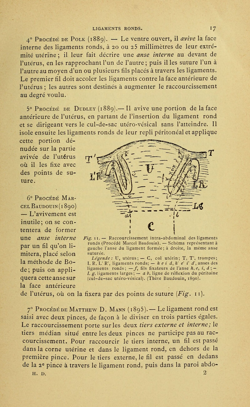 4° Procédé de Polk (1889). — Le ventre ouvert, il avive la face interne des ligaments ronds, à 20 ou 2 5 millimètres de leur extré- mité utérine ; il leur fait décrire une anse interne au devant de l'utérus, en les rapprochant l'un de l'autre; puis il les suture l'un à l'autre au moyen d'un ou plusieurs fils placés à travers les ligaments. Le premier fil doit accoler les ligaments contre la face antérieure de l'utérus ; les autres sont destinés à augmenter le raccourcissement au degré voulu. 5° Procédé de Dudley (1889).— Il avive une portion de la face antérieure de l'utérus, en partant de l'insertion du ligament rond et se dirigeant vers le cul-de-sac utéro-vésical sans l'atteindre. Il isole ensuite les ligaments ronds de leur repli péritonéal et applique cette portion dé- nudée sur la partie avivée de l'utérus où il les fixe avec des points de su- ture. 6° Procédé Mar- cel Baudouin (1890) — L'avivement est inutile; on se con- tentera de former une anse interne par un fil qu'on li- mitera, placé selon la méthode de Bo- de; puis on appli- quera cette anse sur la face antérieure de l'utérus, où on Fig. 11.— Raccourcissement intra-abdominal des ligaments ronds (Procédé Marcel Baudouin). — Schéma représentant à gauche l'anse du ligament formée; à droite, la même anse suturée. Légende: U, utérus;— C, col utérin; T, T', trompes; L R, L' R', ligaments ronds; — h e i d, h' e' i' d\ anses des ligaments ronds; —f, fils fixateurs de l'anse h,e, i, d; — L g, ligaments larges; — a b, ligne de réflexion du péritoine (cul-de-sac utéro-vésical). (Thèse Baudouin, 1890). la fixera par des points de suture [Fig. i1' 70 Procédé de Matthew D. Mann (1895).— Le ligament rond est saisi avec deux pinces, de façon à le diviser en trois parties égales. Le raccourcissement porte sur les deux tiers externe et interne; le tiers médian situé entre les deux pinces ne participe pas au rac- courcissement. Pour raccourcir le tiers interne, un fil est passé dans la corne utérine et dans le ligament rond, en dehors de la première pince. Pour le tiers externe, le fil est passé en dedans de la 2e pince à travers le ligament rond, puis dans la paroi abdo- H. D. 2