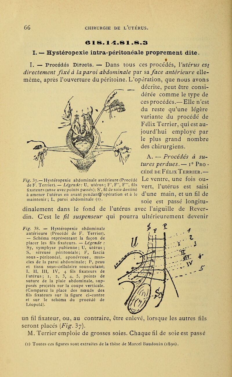 618.14.81.8.3 I. — Hystéropexie intra-péritonéale proprement dite. I. — Procédés Directs. — Dans tous ces procédés, l'utérus est directement fixé à la paroi abdominale par sa face antérieure elle- même, après l'ouverture du péritoine. L'opération, que nous avons décrite, peut être consi- dérée comme le type de cesprocédés.— Elle n'est du reste qu'une légère variante du procédé de Félix Terrier, qui est au- jourd'hui employé par le plus grand nombre des chirurgiens. A. ■— Procédés à su- tures perdues.— i° Pro - cédé de Félix Terrier.— Fig, 3j.— Hystéropexie abdominale antérieure (Procédé Le Ventre, une IOlS OU- de F. Terrier). - Légende :V, utérus ; F', F, F, fils ven pmérus est sajsi fixateurs (anse avec points passes); S , fil de soie destine l'utérus en avant pendantjl'opération et à le d'une main, et Un fil de a amener maintenir L, paroi abdominale (î), soie est passé longitu- 1 cj dinalement dans le fond de l'utérus avec l'aiguille de Rever- din. C'est le fil suspenseur qui pourra ultérieurement devenir Fig. 38. — Hystéropexie abdominale antérieure (Procédé de F. Terrier). — Schéma représentant la façon de placer les fils fixateurs. — Légende : Sy, symphyse pubienne ; U, utérus ; S, séreuse péritonéale ; F, fascia sous - péritonéal, aponévrose, mus- cles de la paroi abdominale; P, peau et tissu so.us-cellulaire sous-cutané; I, II, III, IV, 4 fils fixateurs de l'utérus; i, 2, 3, 4, 5, points de suture de la plaie abdominale, sup- posés projetés sur la coupe verticale. (Comparez la place des nœuds des fils fixateurs sur la figure ci-contre et sur le schéma du procédé de Léopold). un fil fixateur, ou, au contraire, être enlevé, lorsque les autres fils seront placés {Fig. 37). M. Terrier emploie de grosses soies. Chaque fil de soie est passé (1) Toutes ces figures sont extraites de la thèse de Marcel Baudouin (1890).