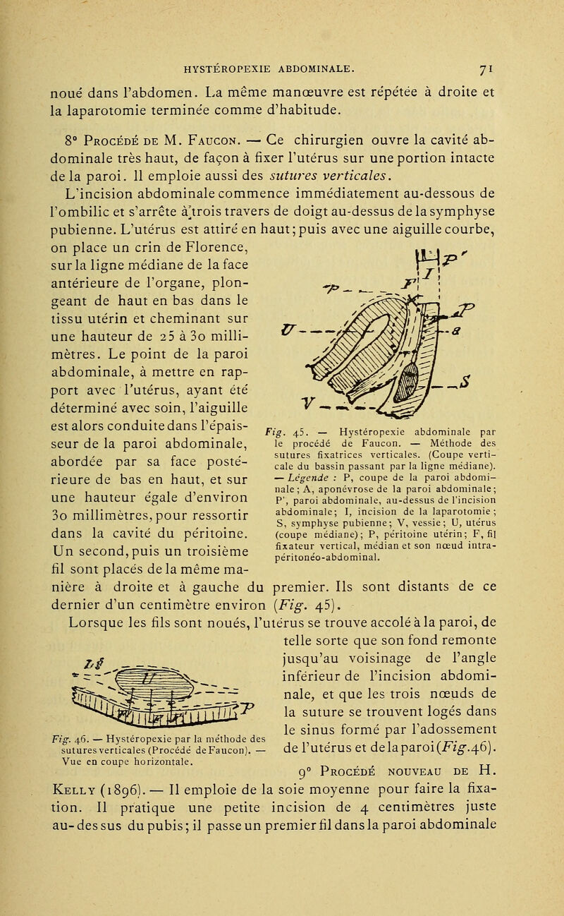 noué dans l'abdomen. La même manœuvre est re'pétée à droite et la laparotomie terminée comme d'habitude. 8° Procédé de M. Faucon. — Ce chirurgien ouvre la cavité ab- dominale très haut, de façon à fixer l'utérus sur une portion intacte delà paroi. 11 emploie aussi des sutwes verticales. L'incision abdominale commence immédiatement au-dessous de l'ombilic et s'arrête à'trois travers de doigt au-dessus de la symphyse pubienne. L'utérus est attiré en haut ; puis avec une aiguille courbe, on place un crin de Florence, sur la ligne médiane de la face antérieure de l'organe, plon- geant de haut en bas dans le tissu utérin et cheminant sur une hauteur de iS à 3o milli- mètres. Le point de la paroi abdominale, à mettre en rap- port avec l'utérus, ayant été déterminé avec soin, l'aiguille est alors conduite dans l'épais- seur de la paroi abdominale, abordée par sa face posté- rieure de bas en haut, et sur une hauteur égale d'environ 3o millimètres, pour ressortir dans la cavité du péritoine. Un second,puis un troisième ir-~-A Fig. 4.5. — Hystéropexie abdominale par le procédé de Faucon. — Méthode des sutures fixatrices verticales. (Coupe verti- cale du bassin passant par la ligne médiane). — Légende : P, coupe de la paroi abdomi- nale ; A, aponévrose de la paroi abdominale; P', paroi abdominale, au-dessus de l'incision abdominale; I, incision de la laparotomie; S, symphyse pubienne; V, vessie; U, utérus (coupe médiane); P, péritoine utérin; F, fil fixateur vertical, médian et son nœud intra- péritonéo-abdominal. fil sont placés de la même ma- nière à droite et à gauche du premier. Ils sont distants de ce dernier d'un centimètre environ (Fig. /\.5). Lorsque les fils sont noués, l'utérus se trouve accolé à la paroi, de telle sorte que son fond remonte jusqu'au voisinage de l'angle inférieur de l'incision abdomi- nale, et que les trois nœuds de la suture se trouvent logés dans le sinus formé par l'adossement de l'utérus et delaparoi(i<ïg\46). 90 Procédé nouveau de H. Kelly (1896). — Il emploie de la soie moyenne pour faire la fixa- tion. Il pratique une petite incision de 4 centimètres juste au-dessus du pubis; il passe un premier fil dans la paroi abdominale Fig. 46. — Hystéropexie par la me'thode des sutures verticales (Procédé de Faucon). — Vue en coupe horizontale.