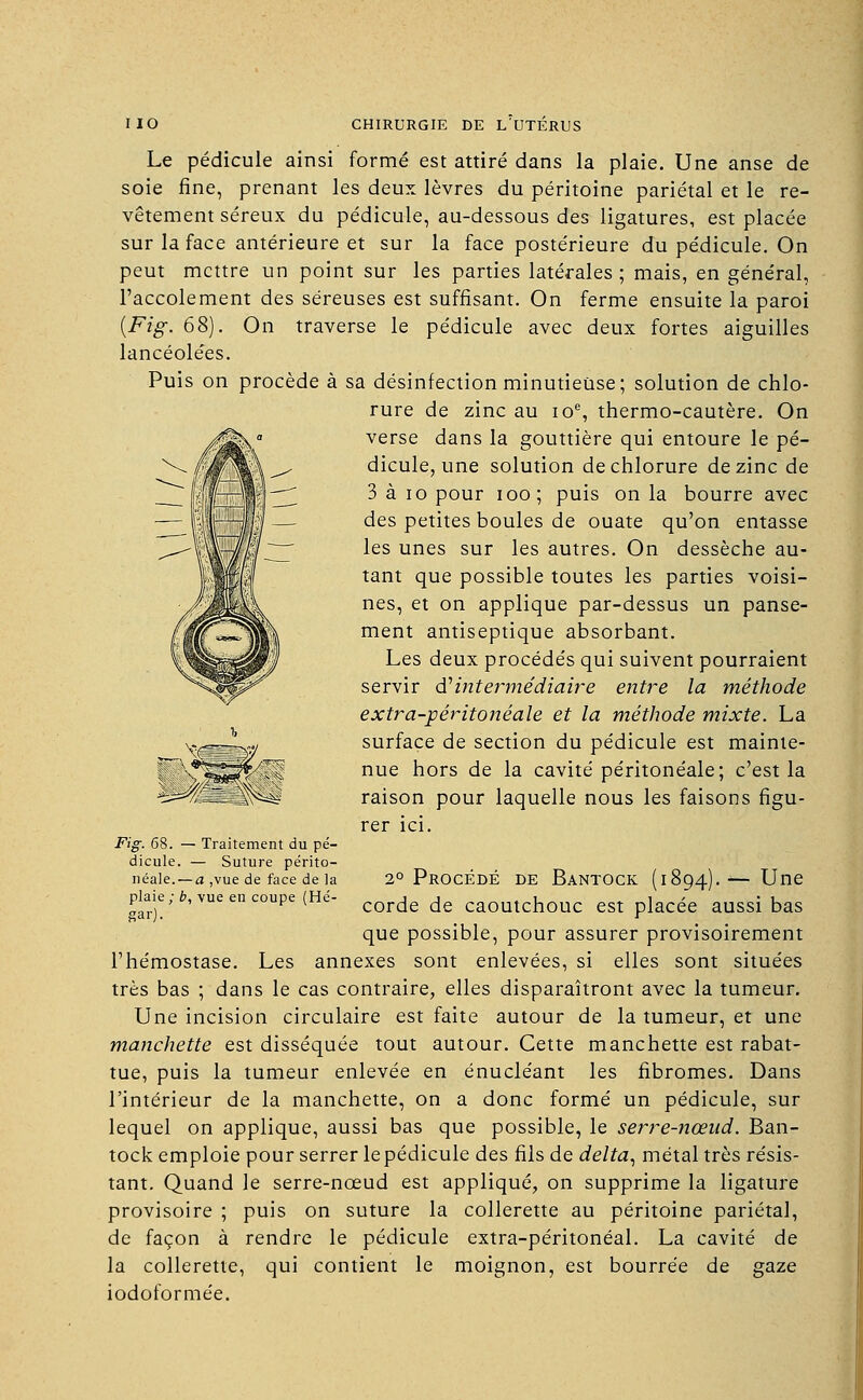 Le pédicule ainsi formé est attiré dans la plaie. Une anse de soie fine, prenant les deux lèvres du péritoine pariétal et le re- vêtement séreux du pédicule, au-dessous des ligatures, est placée sur la face antérieure et sur la face postérieure du pédicule. On peut mettre un point sur les parties latérales; mais, en général, l'accolement des séreuses est suffisant. On ferme ensuite la paroi {Fig. 68). On traverse le pédicule avec deux fortes aiguilles lancéolées. Puis on procède à sa désinfection minutieuse; solution de chlo- rure de zinc au 10e, thermo-cautère. On verse dans la gouttière qui entoure le pé- dicule, une solution de chlorure de zinc de 3 à 10 pour ioo; puis on la bourre avec des petites boules de ouate qu'on entasse les unes sur les autres. On dessèche au- tant que possible toutes les parties voisi- nes, et on applique par-dessus un panse- ment antiseptique absorbant. Les deux procédés qui suivent pourraient servir ^intermédiaire entre la méthode extra-péritoîiéale et la méthode mixte. La surface de section du pédicule est mainte- nue hors de la cavité péritonéale; c'est la raison pour laquelle nous les faisons figu- rer ici. Fig. 68. — Traitement du pé- dicule. — Suture périto- néale.— a ,vue de face de la plaie ; b, vue en coupe (Hé- 2° Procédé de Bantock (1894).— Une corde de caoutchouc est placée aussi bas que possible, pour assurer provisoirement l'hémostase. Les annexes sont enlevées, si elles sont situées très bas ; dans le cas contraire, elles disparaîtront avec la tumeur. Une incision circulaire est faite autour de la tumeur, et une manchette est disséquée tout autour. Cette manchette est rabat- tue, puis la tumeur enlevée en énucléant les fibromes. Dans l'intérieur de la manchette, on a donc formé un pédicule, sur lequel on applique, aussi bas que possible, le serre-nœud. Ban- tock emploie pour serrer le pédicule des fils de delta, métal très résis- tant. Quand le serre-nœud est appliqué, on supprime la ligature provisoire ; puis on suture la collerette au péritoine pariétal, de façon à rendre le pédicule extra-péritonéal. La cavité de la collerette, qui contient le moignon, est bourrée de gaze iodoformée.