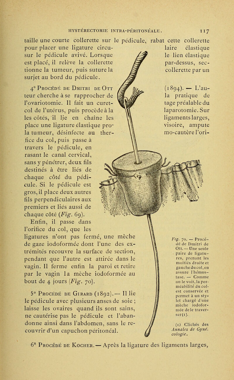 laire élastique le lien élastique par-dessus, sec- collerette par un i 894). — L'au- la pratique de tage préalable du laparotomie. Sur ligaments larges, visoire, ampute mo-cautèrel'ori- HYSTERECTOMIE INTRA-PERITONEALE . I I 7 taille une courte collerette sur le pédicule, rabat cette collerette pour placer une ligature circu- sur le pédicule avivé. Lorsque est placé, il relève la collerette tionne la tumeur, puis suture la surjet au bord du pédicule. 40 Procédé de Dmitri de Ott teur cherche à se rapprocher de l'ovariotomie. Il fait un curet- col de l'utérus, puis procède à la les côtés, il lie en chaîne les place une ligature élastique pro- la tumeur, désinfecte au ther- fice du col, puis passe à travers le pédicule, en rasant le canal cervical, sans y pénétrer, deux fils destinés à être liés de chaque côté du pédi- cule. Si le pédicule est gros, il place deux autres fils perpendiculaires aux premiers et liés aussi de chaque côté (Fig. 69). Enfin, il passe dans l'orifice du col, que les ligatures n'ont pas fermé, une mèche de gaze iodoformée dont l'une des ex- trémités recouvre la surface de section, pendant que l'autre est attirée dans le vagin. Il ferme enfin la paroi et retire par le vagin la mèche iodoformée au bout de 4 jours (Fig. 70). 5° Procédé de Girard (1892).— Il lie le pédicule avec plusieurs anses de soie ; laisse les ovaires quand ils sont sains, ne cautérise pas le pédicule et l'aban- donne ainsi dans l'abdomen, sans le re- couvrir d'un capuchon péritonéal. Ftg. 70. — Procé- dé de Dmitri de Ott. — Une seule paire de ligatu- res, prenant les moitiés droite et gaucheducol,en assure l'hémos- tase. — Comme on le voit, la per- méabilité du col- est conservée et permet à un sty- et chargé d'une mèche iodofor- mée de le traver- ser(i). 1) Clichés des Annales de Gyne. gie. 6° Procédé de Kocher. — Après la ligature des ligaments larges,