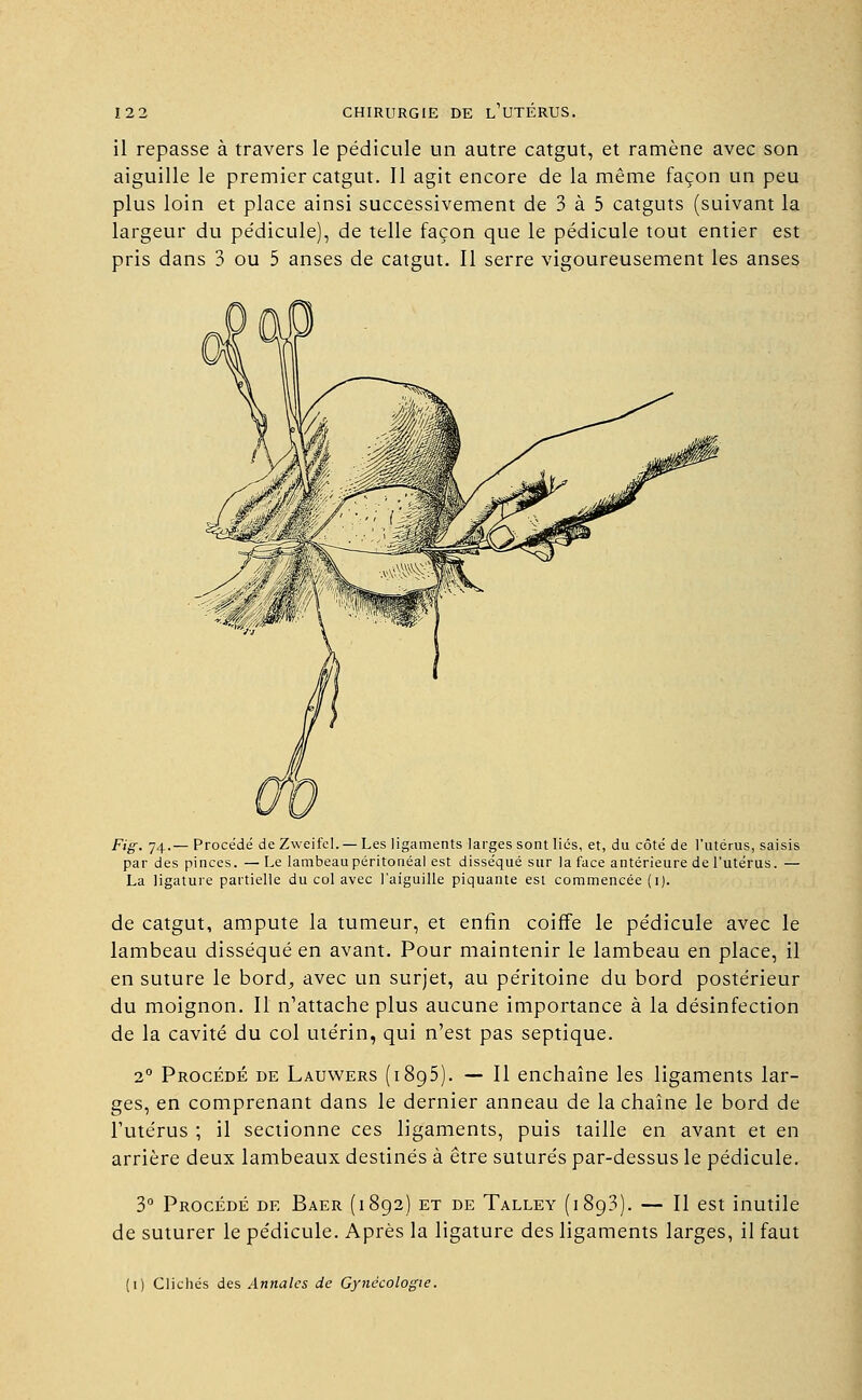 il repasse à travers le pédicule un autre catgut, et ramène avec son aiguille le premier catgut. Il agit encore de la même façon un peu plus loin et place ainsi successivement de 3 à 5 catguts (suivant la largeur du pe'dicule), de telle façon que le pédicule tout entier est pris dans 3 ou 5 anses de catgut. Il serre vigoureusement les anses Fig. 74.— Procédé de ZweifeL— Les ligaments larges sont lies, et, du côté de l'utérus, saisis par des pinces. — Le lambeaupéritonéal est disséqué sur la face antérieure de l'utérus. — La ligature partielle du col avec l'aiguille piquante est commencée (i). de catgut, ampute la tumeur, et enfin coiffe le pédicule avec le lambeau disséqué en avant. Pour maintenir le lambeau en place, il en suture le bord,, avec un surjet, au péritoine du bord postérieur du moignon. Il n'attache plus aucune importance à la désinfection de la cavité du col utérin, qui n'est pas septique. 20 Procédé de Lauwers (i8g5). — Il enchaîne les ligaments lar- ges, en comprenant dans le dernier anneau de la chaîne le bord de l'utérus ; il sectionne ces ligaments, puis taille en avant et en arrière deux lambeaux destinés à être suturés par-dessus le pédicule. 3° Procédé de Baer (1892) et de Talley (1893). — Il est inutile de suturer le pédicule. Après la ligature des ligaments larges, il faut