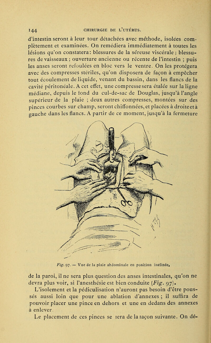 d'intestin seront à leur tour détachées avec méthode, isolées com- plètement et examinées. On remédiera immédiatement à toutes les lésions qu'on constatera: blessures de la séreuse viscérale ; blessu- res de vaisseaux; ouverture ancienne ou récente de l'intestin ; puis les anses seront refoulées en bloc vers le ventre. On les protégera avec des compresses stériles, qu'on disposera de façon à empêcher tout écoulement de liquide, venant du bassin, dans les flancs de la cavité péritonéale. A cet effet, une compresse sera étalée sur la ligne médiane, depuis le fond du cul-de-sac de Douglas, jusqu'à l'angle supérieur de la plaie ; deux autres compresses, montées sur des pinces courbes sur champ, seront chiffonnées, et placées à droiteetà <*auche dans les flancs. A partir de ce moment, jusqu'à la fermeture Fig. 97. — Vue de la plaie abdominale en position inclinée, de la paroi, il ne sera plus question des anses intestinales, qu'on ne devra plus voir, si l'anesthésie est bien conduite [Fig. 97). L'isolement et la pédiculisation n'auront pas besoin d'être pous- sés aussi loin que pour une ablation d'annexés ; il suffira de pouvoir placer une pince en dehors et une en dedans des annexes à enlever. Le placement de ces pinces se rera de la raçon suivante. On dé-