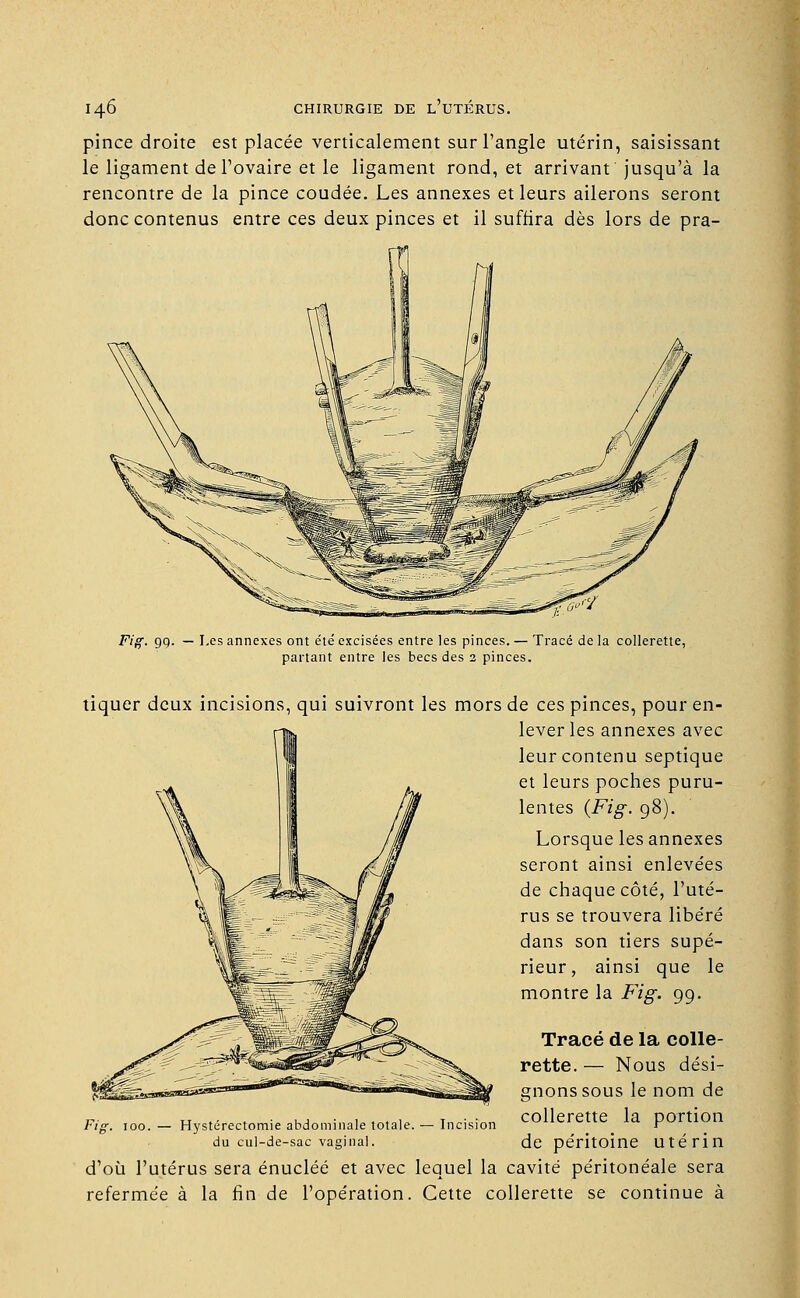 pince droite est placée verticalement sur l'angle utérin, saisissant le ligament de l'ovaire et le ligament rond, et arrivant jusqu'à la rencontre de la pince coudée. Les annexes et leurs ailerons seront donc contenus entre ces deux pinces et il suffira dès lors de pra- Fig. gg. — Les annexes ont été' excisées entre les pinces. — Tracé de la collerette, partant entre les becs des 2 pinces. tiquer deux incisions, qui suivront les mors de ces pinces, pour en- lever les annexes avec leur contenu septique et leurs poches puru- lentes {Fig. 98). Lorsque les annexes seront ainsi enlevées de chaque côté, l'uté- rus se trouvera libéré dans son tiers supé- rieur, ainsi que le montre la Fig. 99. Tracé de la colle- rette. — Nous dési- gnons sous le nom de collerette la portion de péritoine uté rin d'où l'utérus sera énucléé et avec lequel la cavité péritonéale sera refermée à la fin de l'opération. Cette collerette se continue à Fi Hystérectomie abdominale totale, du cul-de-sac vaginal. Incision