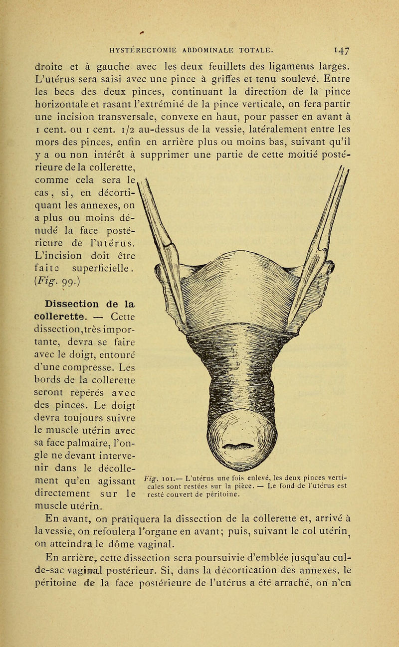 droite et à gauche avec les deux feuillets des ligaments larges. L'ute'rus sera saisi avec une pince à griffes et tenu soulevé. Entre les becs des deux pinces, continuant la direction de la pince horizontale et rasant l'extrémité de la pince verticale, on fera partir une incision transversale, convexe en haut, pour passer en avant à 1 cent, ou 1 cent. 1/2 au-dessus de la vessie, latéralement entre les mors des pinces, enfin en arrière plus ou moins bas, suivant qu'il y a ou non intérêt à supprimer une partie de cette moitié posté- rieure de la collerette, comme cela sera le cas, si, en décorti- quant les annexes, on a plus ou moins dé- nudé la face posté- rieure de l'utérus. L'incision doit être faite superficielle. [Fig. 99.) Dissection de la collerette. — Cette dissection,très impor- tante, devra se faire avec le doigt, entouré d'une compresse. Les bords de la collerette seront repérés avec des pinces. Le doigt devra toujours suivre le muscle utérin avec sa face palmaire, l'on- gle ne devant interve- nir dans le décolle- ment qu'en agissant directement sur le muscle utérin. En avant, on pratiquera la dissection de la collerette et, arrivé à la vessie, on refoulera l'organe en avant; puis, suivant le col utérin on atteindra Je dôme vaginal. En arrière;, cette dissection sera poursuivie d'emblée jusqu'au cul- de-sac vagiiîa.1 postérieur. Si, dans la décortication des annexes, le péritoine de la face postérieure de l'utérus a été arraché, on n'en Fig. 101.— L'utérus une fois enlevé, les deux pinces verti- cales sont restées sur la pièce. — Le fond de l'utérus est resté couvert de péritoine.