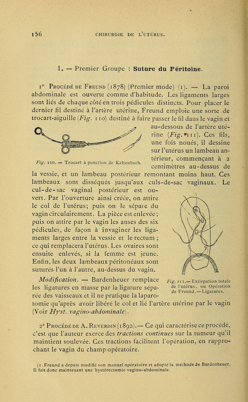 Fig. uo. — Trocart à ponction de Kaltenbach. I. — Premier Groupe : Suture du Péritoine. i° Procédé de Freund (1878) (Premier mode) (1). — La paroi abdominale est ouverte comme d'habitude. Les ligaments larges sont liés de chaque côté en trois pédicules distincts. Pour placer le dernier fil destiné à l'artère utérine, Freund emploie une sorte de trocart-aiguille [Fig. 110) destiné à faire passer le fil dans le vagin et au-dessous de l'artère uté- rine [Fig.•m). Ces fils, une fois noués, il dessine sur l'utérus un lambeau an- térieur, commençant à 2 centimètres au-dessus de la vessie, et un lambeau postérieur remontant moins haut. Ces lambeaux sont disséqués jusqu'aux culs-de-sac vaginaux. Le cul-de-sac vaginal postérieur est ou- vert. Par l'ouverture ainsi créée, on attire le col de l'utérus; puis on le sépare du vagincirculairement. La pièce est enlevée; puis on attire par le vagin les anses des six pédicules, de façon à invaginer les liga- ments larges entre la vessie et le rectum ; ce qui remplacera l'utérus. Les ovaires sont ensuite enlevés, si la femme est jeune. Enfin, les deux lambeaux péritonéaux sont suturés l'un à l'autre, au-dessus du vagin. Modification. — Bardenheuer remplace les ligatures en masse par la ligature sépa- rée des vaisseaux et il ne pratique la laparo- tomie qu'après avoir libéré le col et lié l'artère utérine par le vagin (Voir Hyst. vagino-abdominalé]. 20 Procédéde A.Reverdin(i892).— Ce qui caractérise ce procédé, c'est que l'auteur exerce des tractions continues sur la tumeur qu'il maintient soulevée. Ces tractions facilitent l'opération, en rappro- chant le vagin du champ opératoire. Fig. i11.— Extirpation totale de l'utérus, ou Opération de Freund.— Ligatures. (1. Freund a depuis modifié son manuel opératoire et adopté la méthode de Bardenheuer. Il fait donc maintenant une hystérectomie vagino-abdominale.