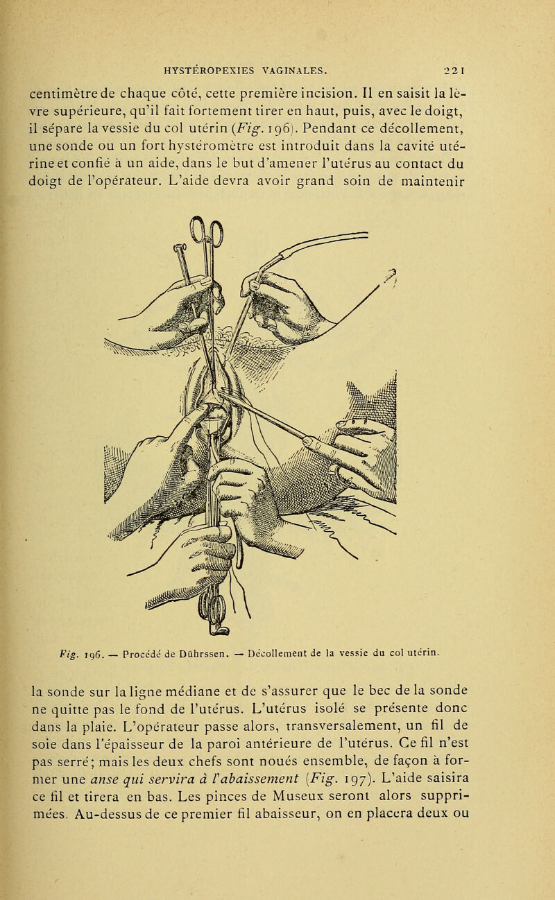 centimètre de chaque côté, cette première incision. Il en saisit la lè- vre supérieure, qu'il fait fortement tirer en haut, puis, avec le doigt, il sépare la vessie du col utérin {Fig. 196). Pendant ce décollement, une sonde ou un fort hystéromètre est introduit dans la cavité uté- rine et confié à un aide, dans le but d'amener l'utérus au contact du doigt de l'opérateur. L'aide devra avoir grand soin de maintenir Fig. 196. — Procédé de Dûhrssen. — Décollement de la vessie du col utérin. la sonde sur la ligne médiane et de s'assurer que le bec de la sonde ne quitte pas le fond de l'utérus. L'utérus isolé se présente donc dans la plaie. L'opérateur passe alors, transversalement, un fil de soie dans l'épaisseur de la paroi antérieure de l'utérus. Ce fil n'est pas serré; mais les deux chefs sont noués ensemble, de façon à for- mer une anse qui servira à rabaissement [Fig. 197). L'aide saisira ce fil et tirera en bas. Les pinces de Museux seront alors suppri- mées. Au-dessus de ce premier fil abaisseur, on en placera deux ou