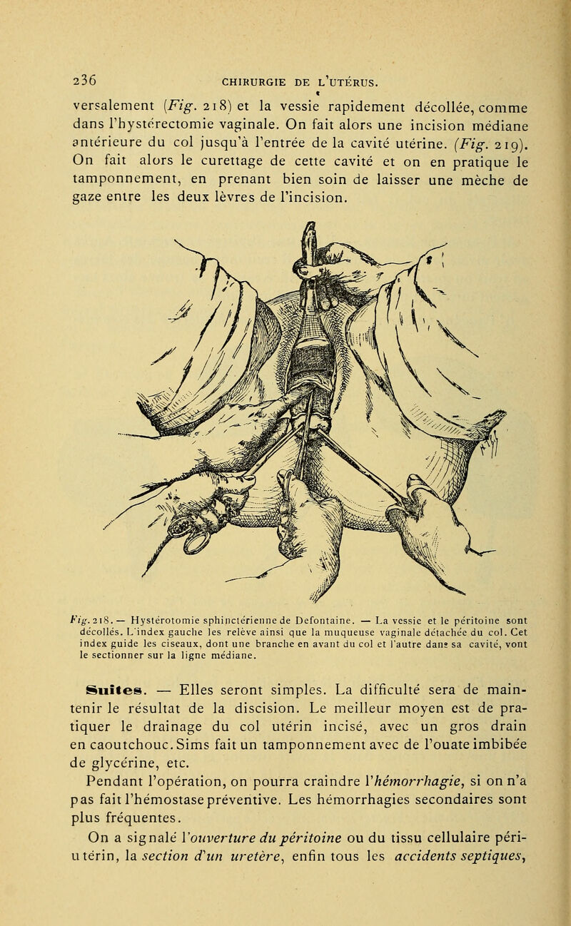 versalement [Fig. 218) et la vessie rapidement décollée, comme dans Thystérectomie vaginale. On fait alors une incision médiane antérieure du col jusqu'à l'entrée de la cavité utérine. (Fig. 219). On fait alors le curettage de cette cavité et on en pratique le tamponnement, en prenant bien soin de laisser une mèche de gaze entre les deux lèvres de l'incision. Fig.218.— Hystérotomie sphinctérienne de Defontaine. — La vessie et le péritoine sont décollés. L'index gauche les relève ainsi que la muqueuse vaginale détachée du col. Cet index guide les ciseaux, dont une branche en avant du col et l'autre dans sa cavité, vont le sectionner sur la ligne médiane. Suites. — Elles seront simples. La difficulté sera de main- tenir le résultat de la discision. Le meilleur moyen est de pra- tiquer le drainage du col utérin incisé, avec un gros drain en caoutchouc. Sims fait un tamponnement avec de l'ouate imbibée de glycérine, etc. Pendant l'opération, on pourra craindre Yhémorrhagie, si on n'a pas fait l'hémostase préventive. Les hémorrhagies secondaires sont plus fréquentes. On a signalé l'ouverture du péritoine ou du tissu cellulaire péri- utérin, la section d'un uretère, enfin tous les accidents septiques,